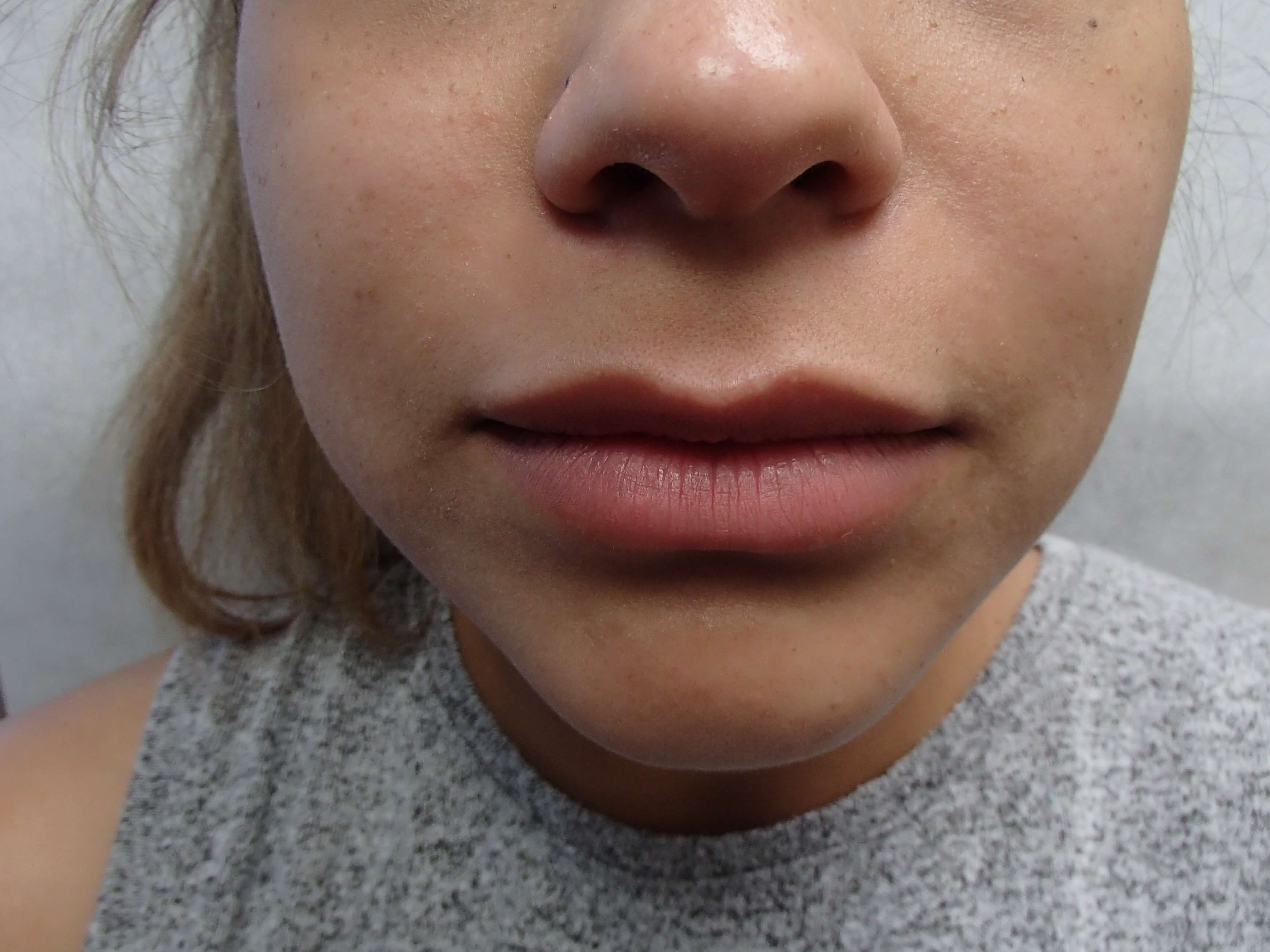 Buccal Fat Pad Removal Before