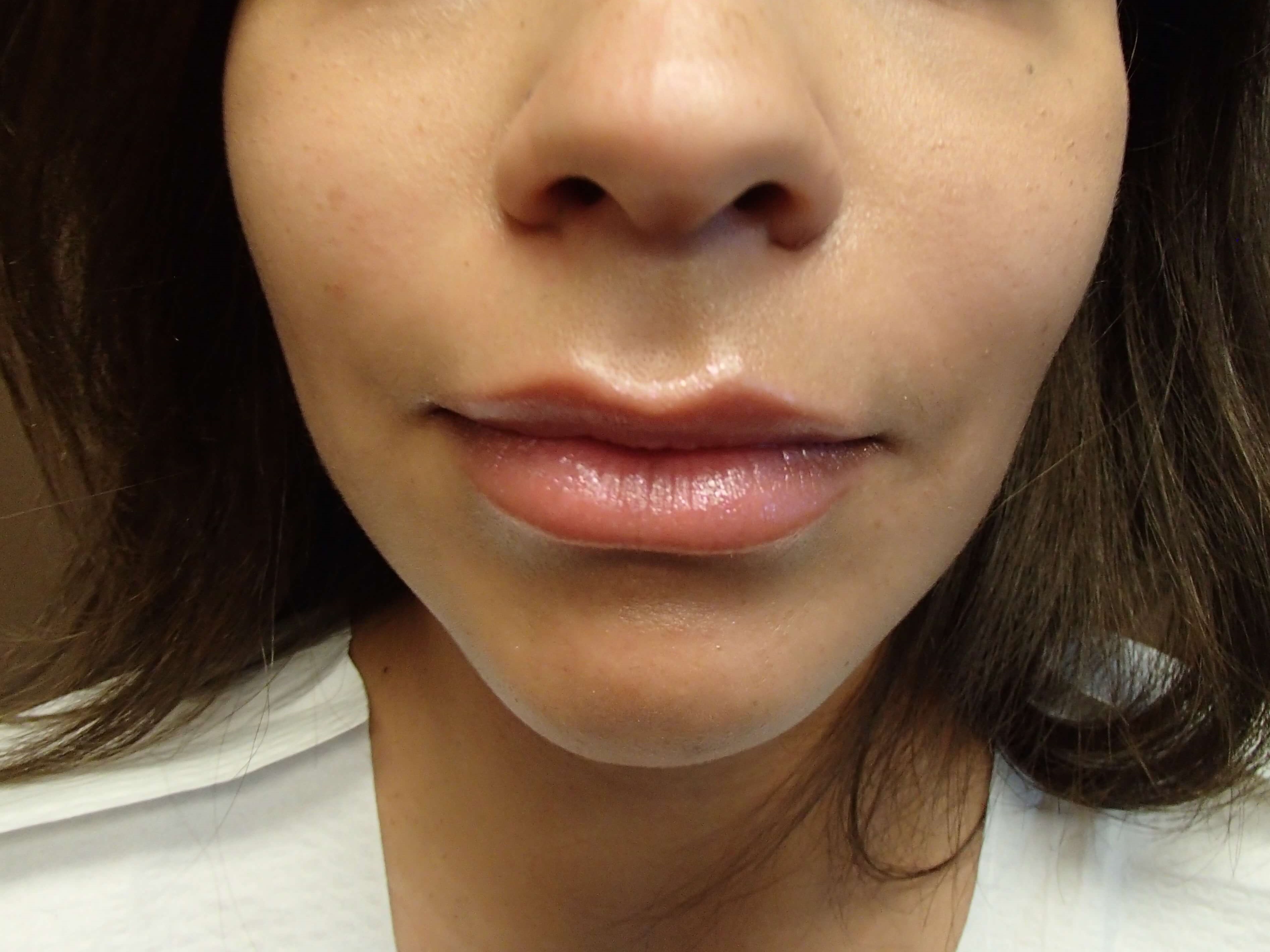 Buccal Fat Pad Removal After