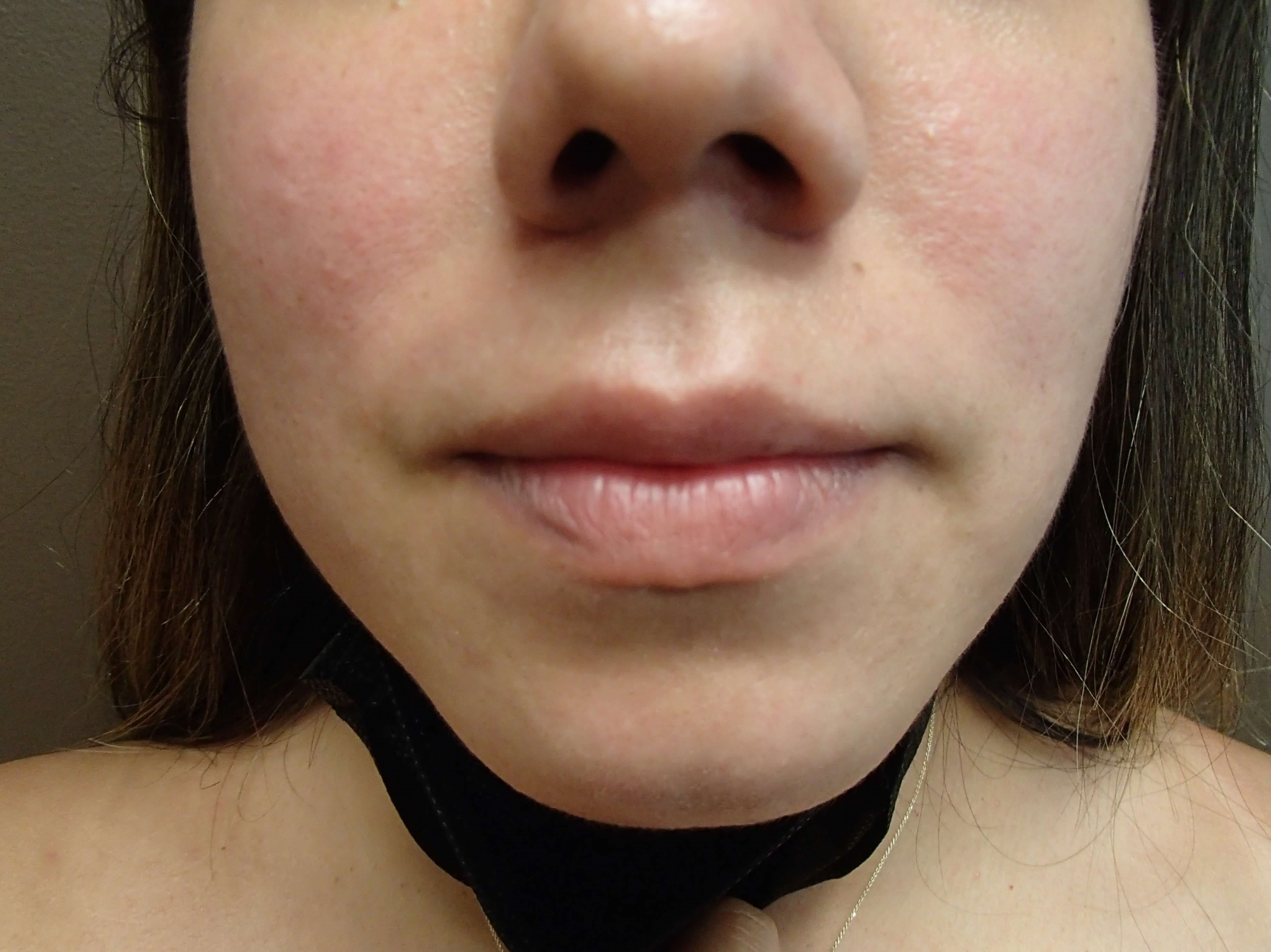 Buccal Fat Pad Removal After