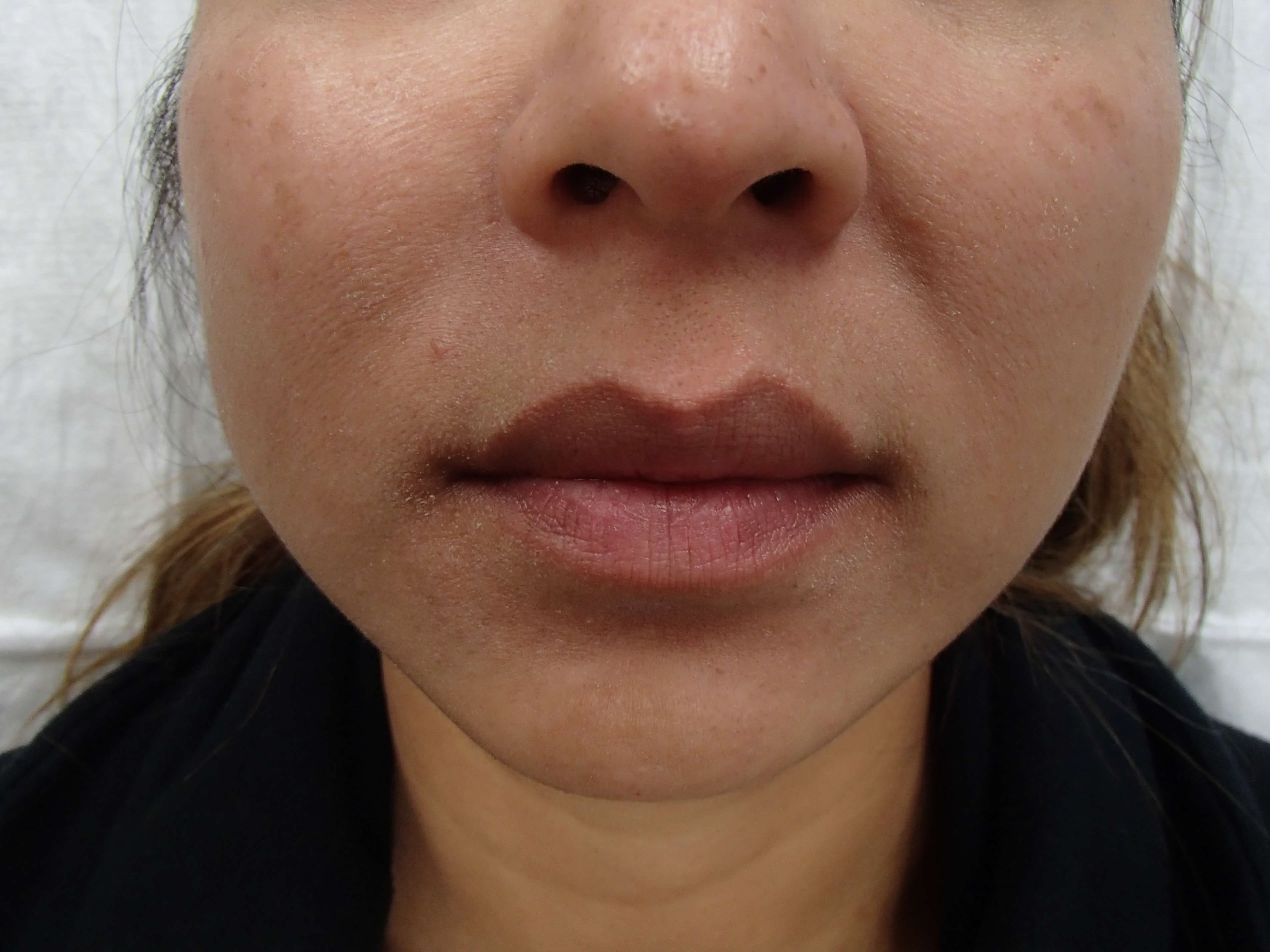 Buccal Fat Pad Removal Before