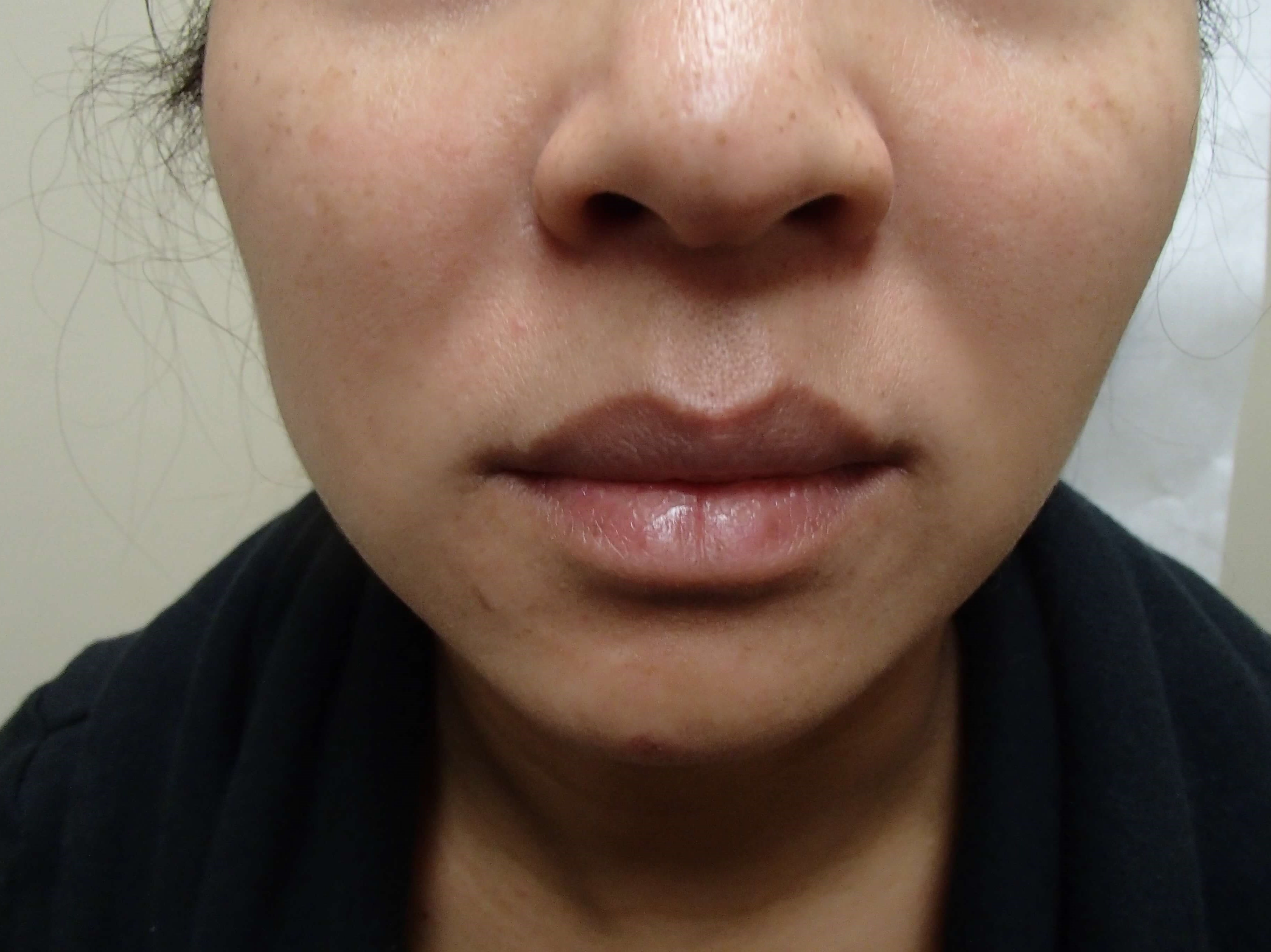 Buccal Fat Pad Removal After