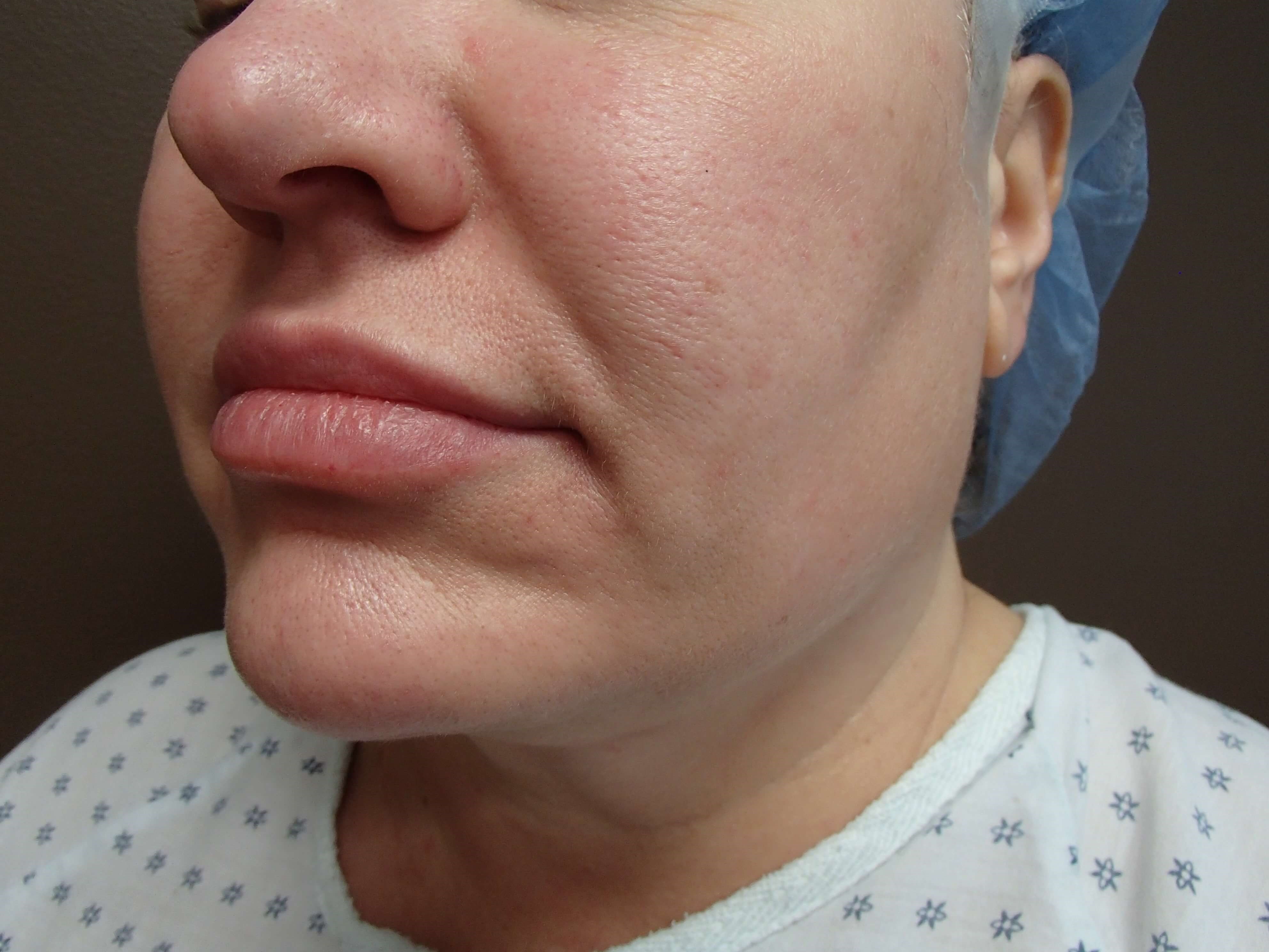 Neck Liposuction Before
