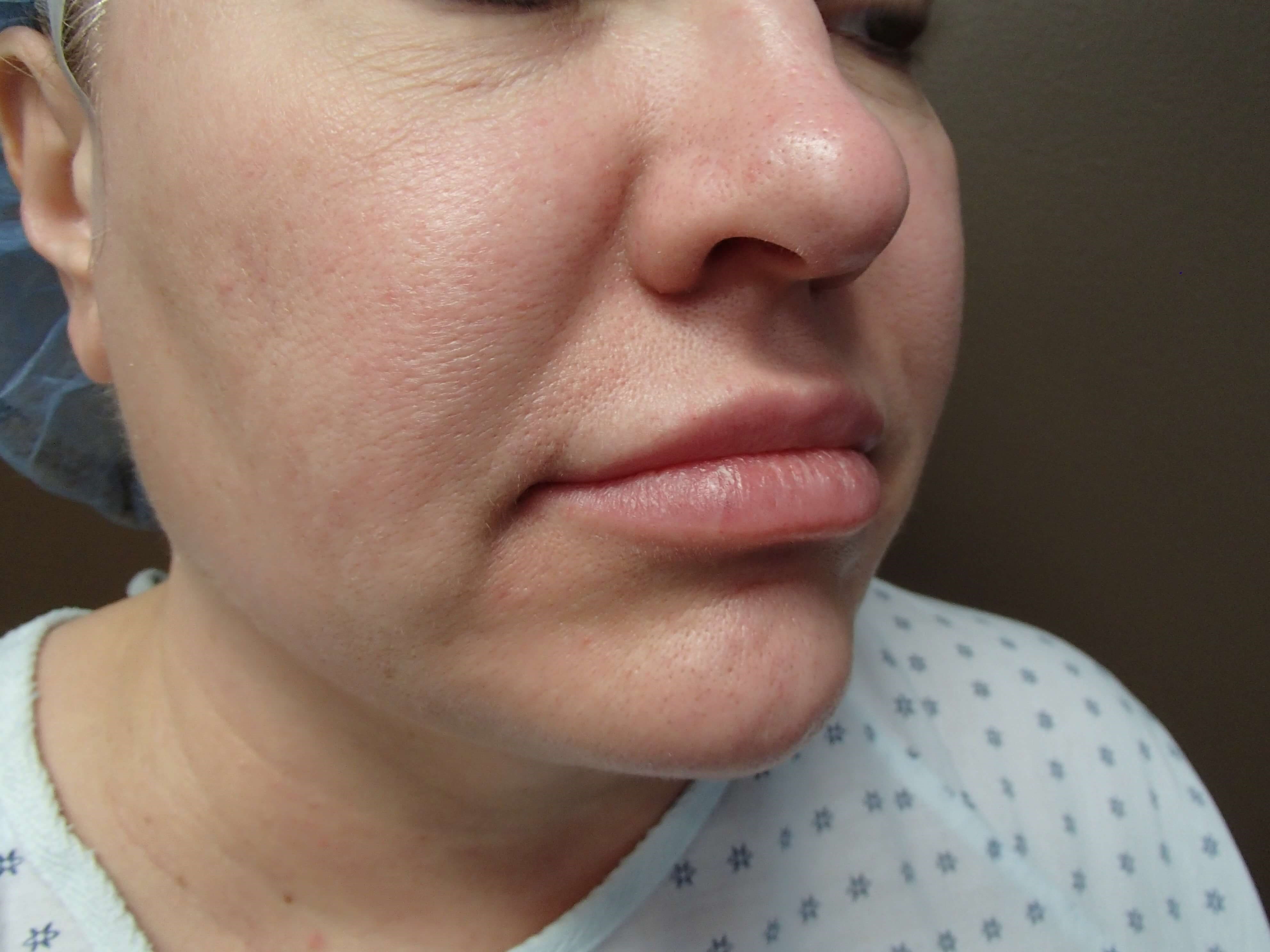 Neck Liposuction Before