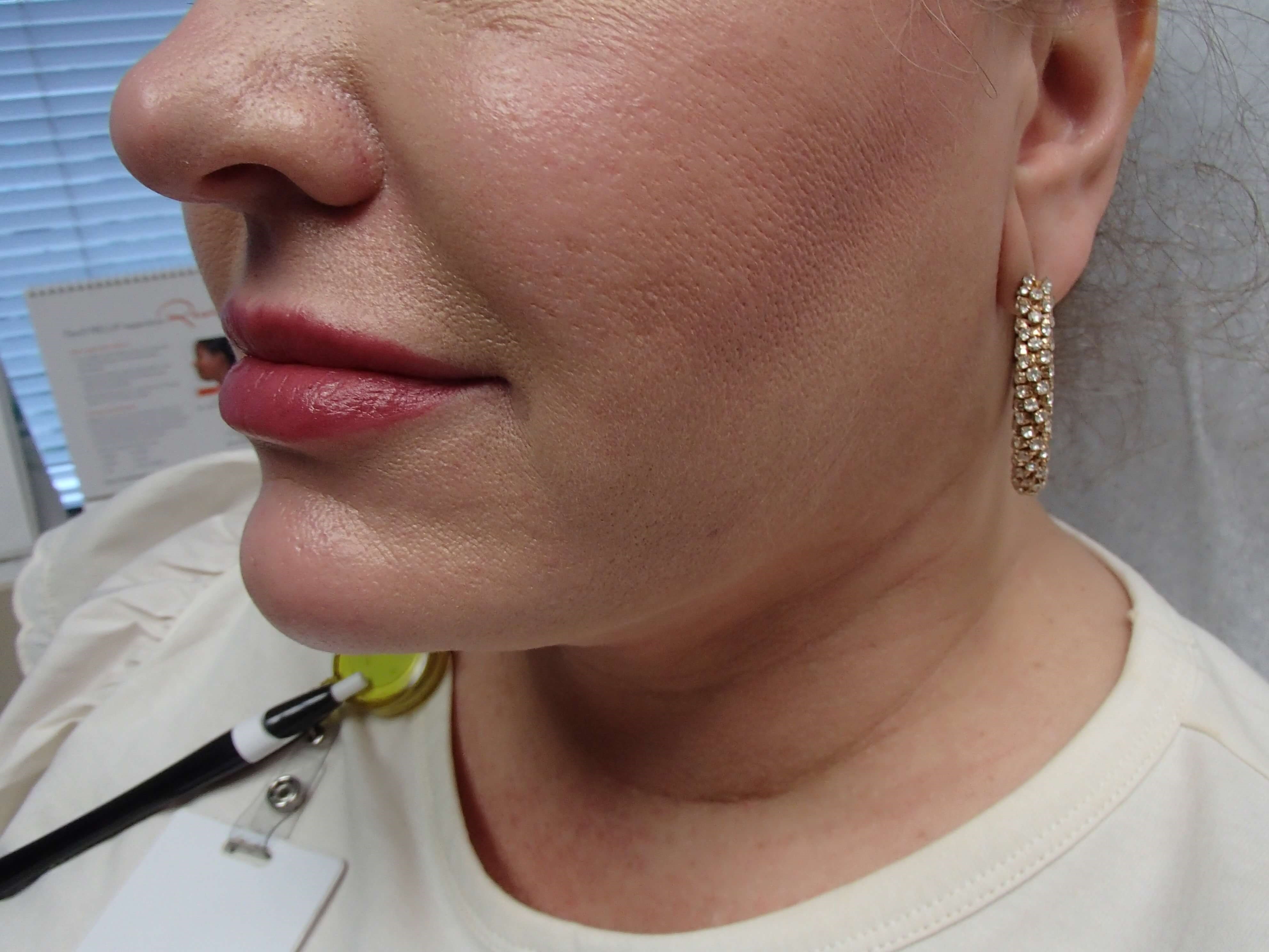 Neck Liposuction After