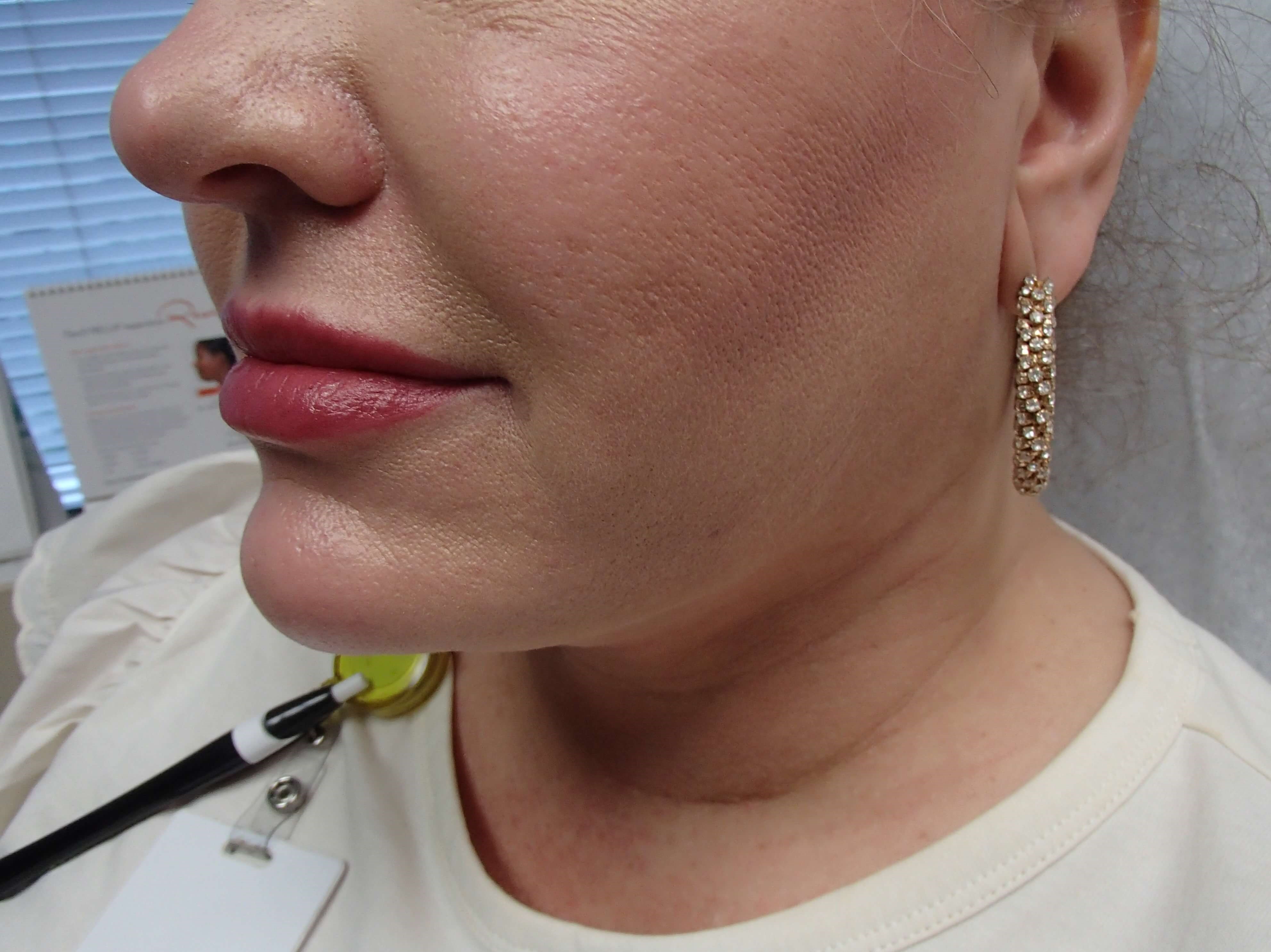 Neck Liposuction After