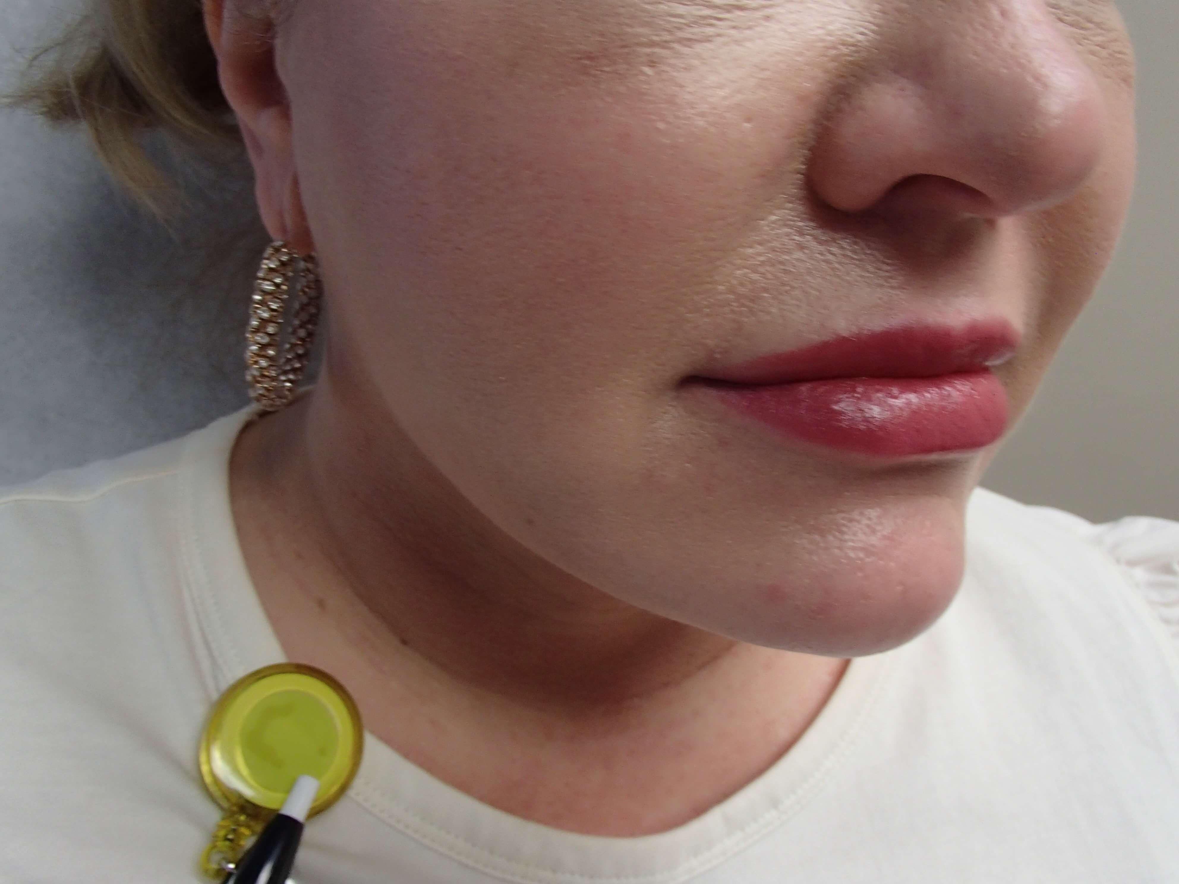 Neck Liposuction After