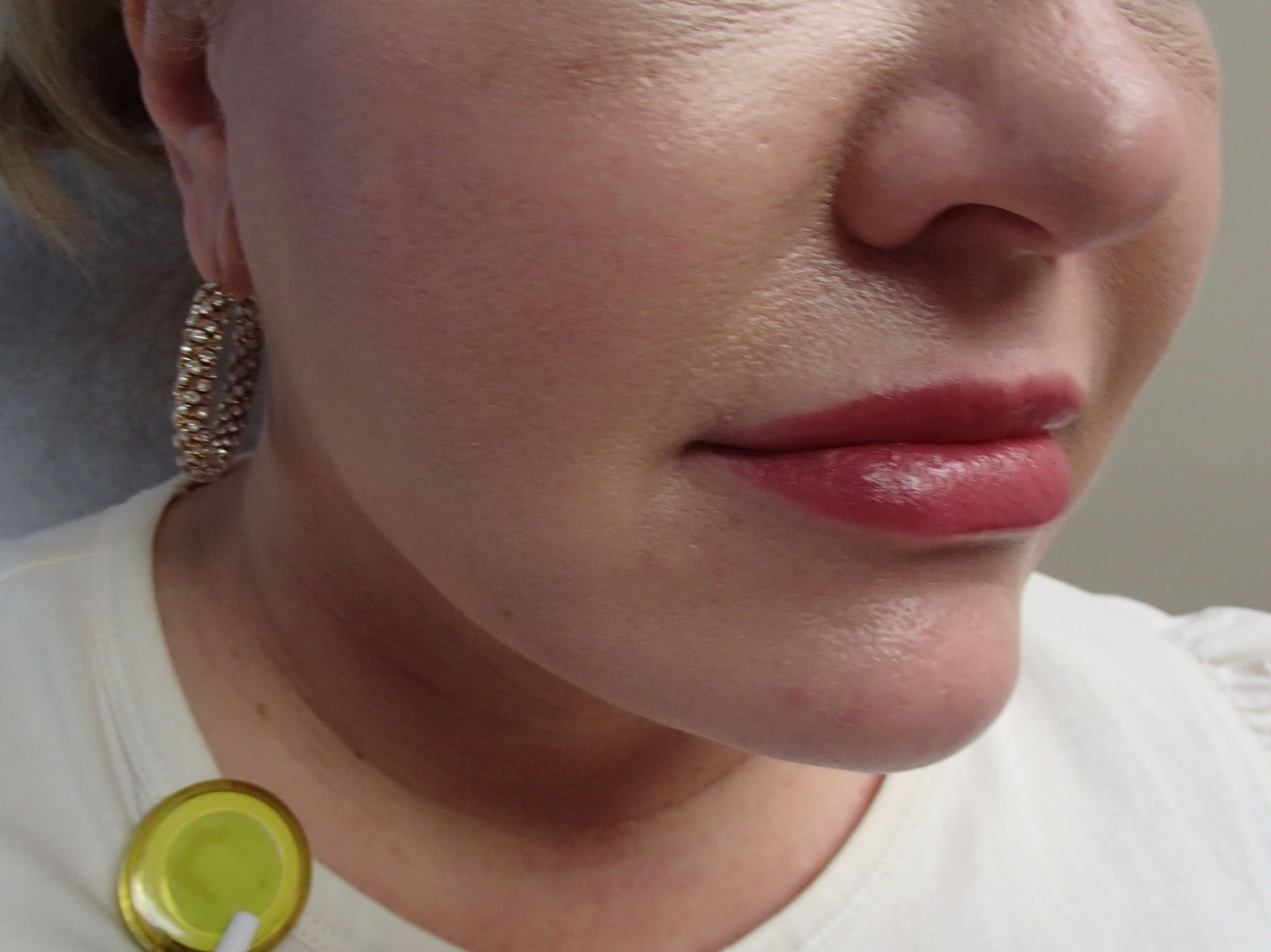 Neck Liposuction After