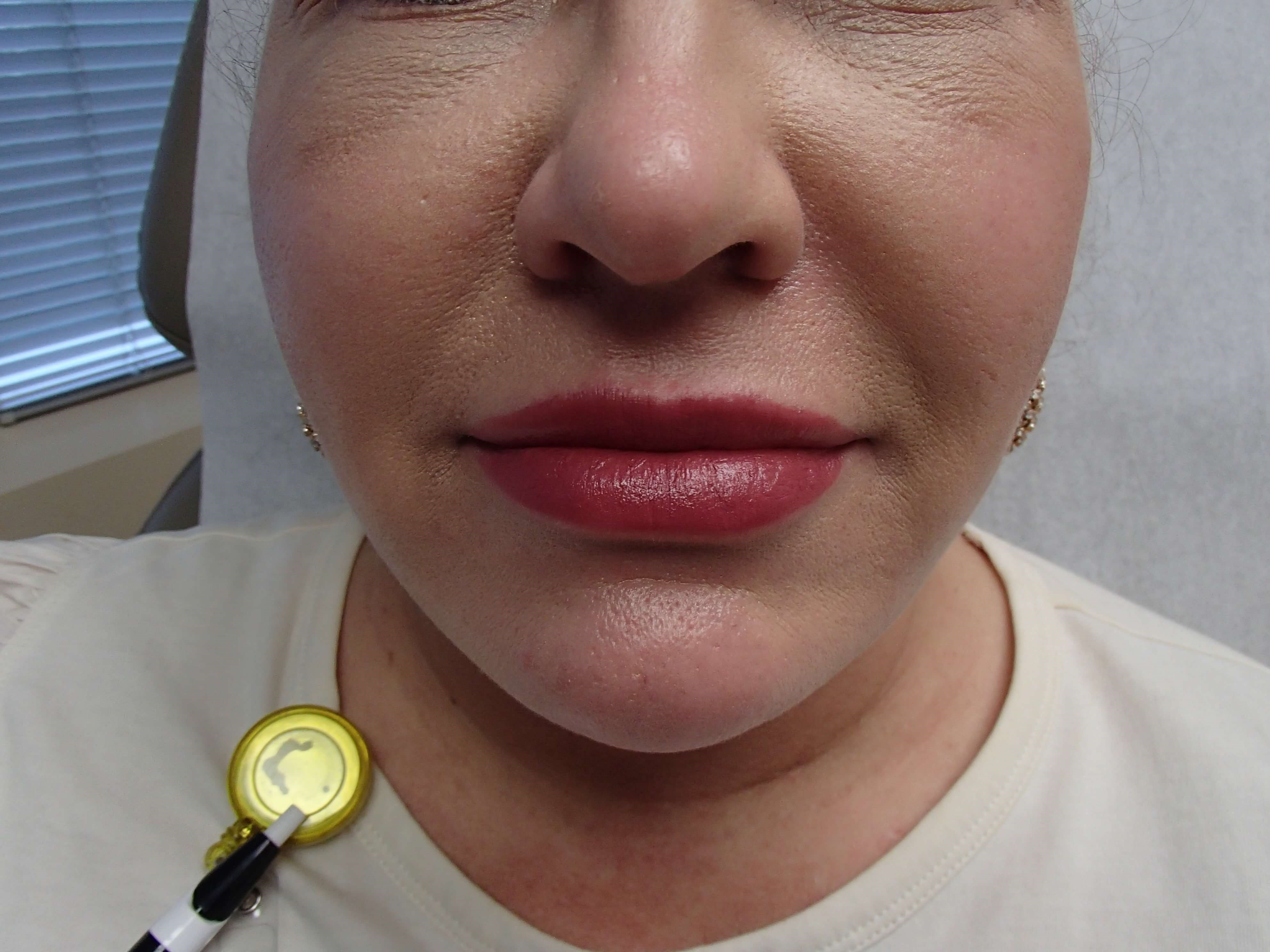 Neck Liposuction After