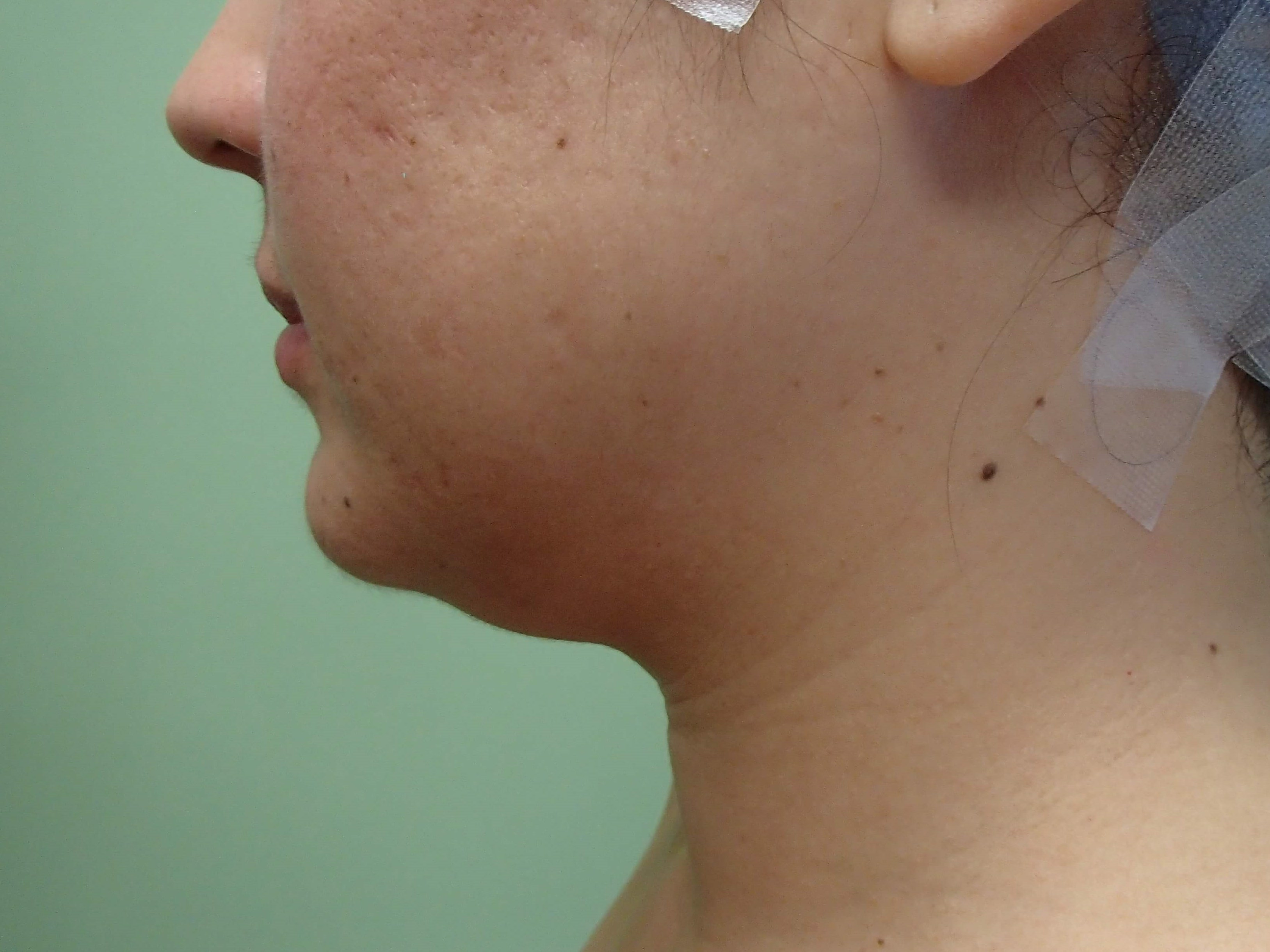 Neck Liposuction Before
