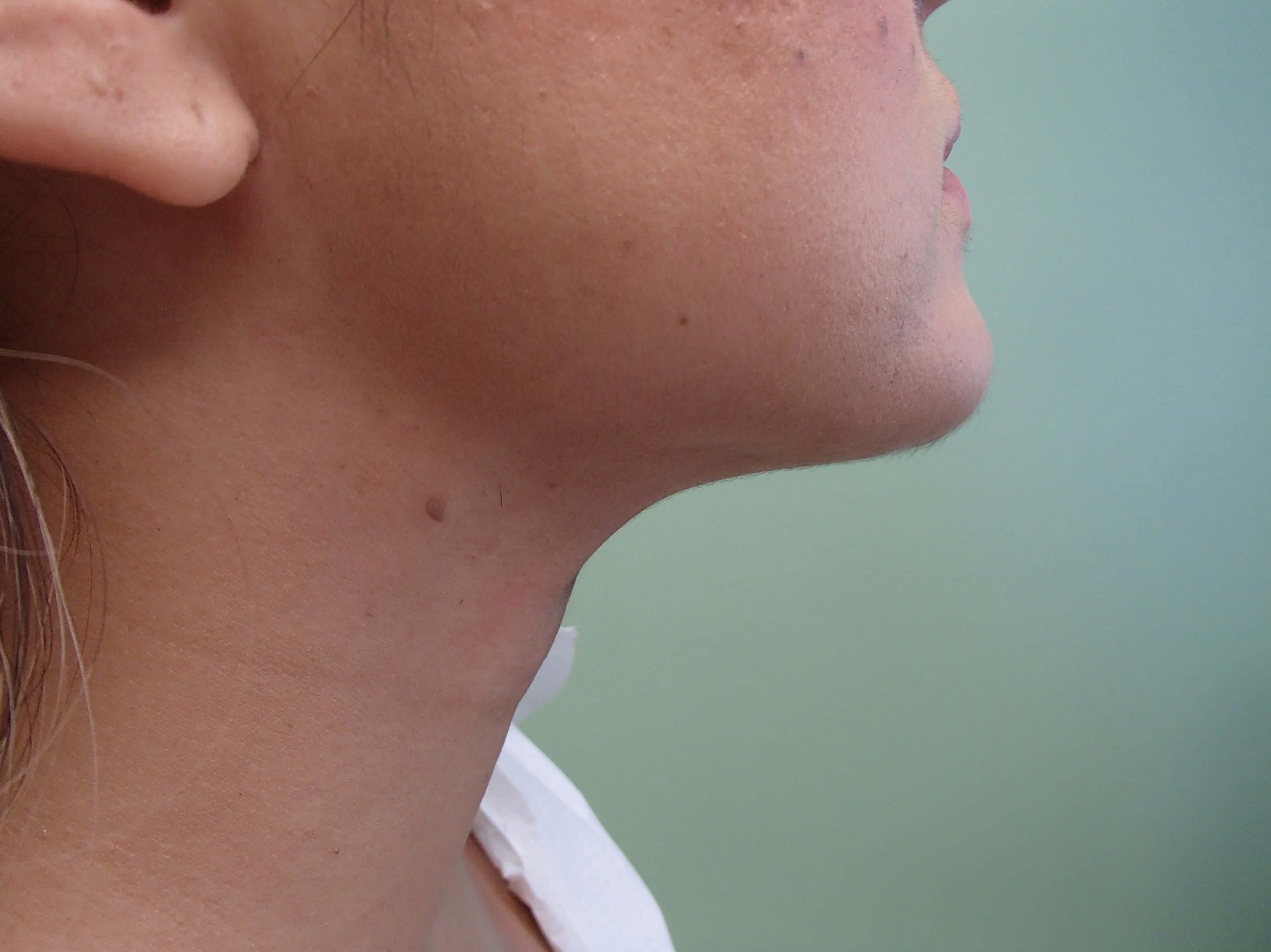 Neck Liposuction After