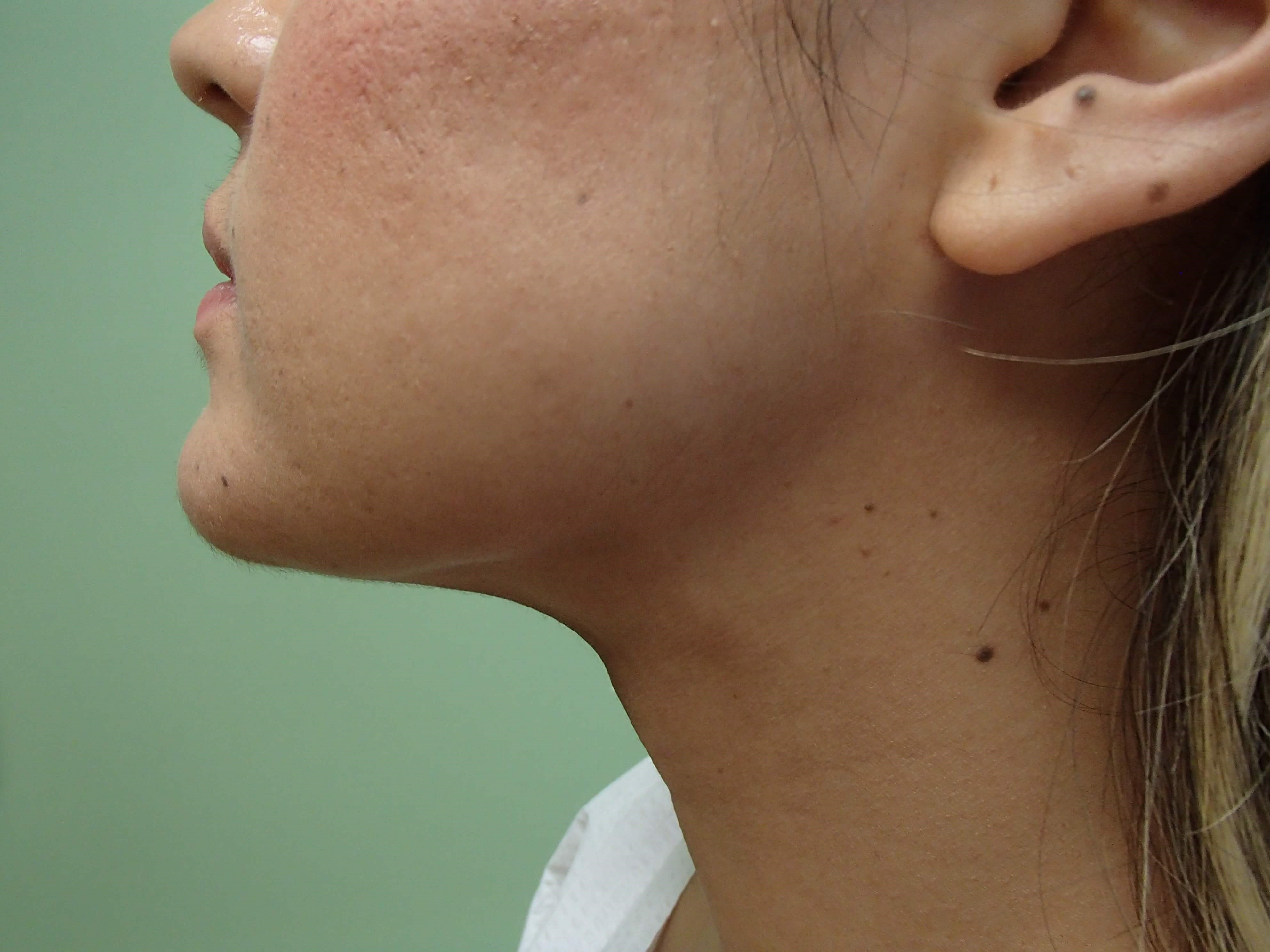 Neck Liposuction After