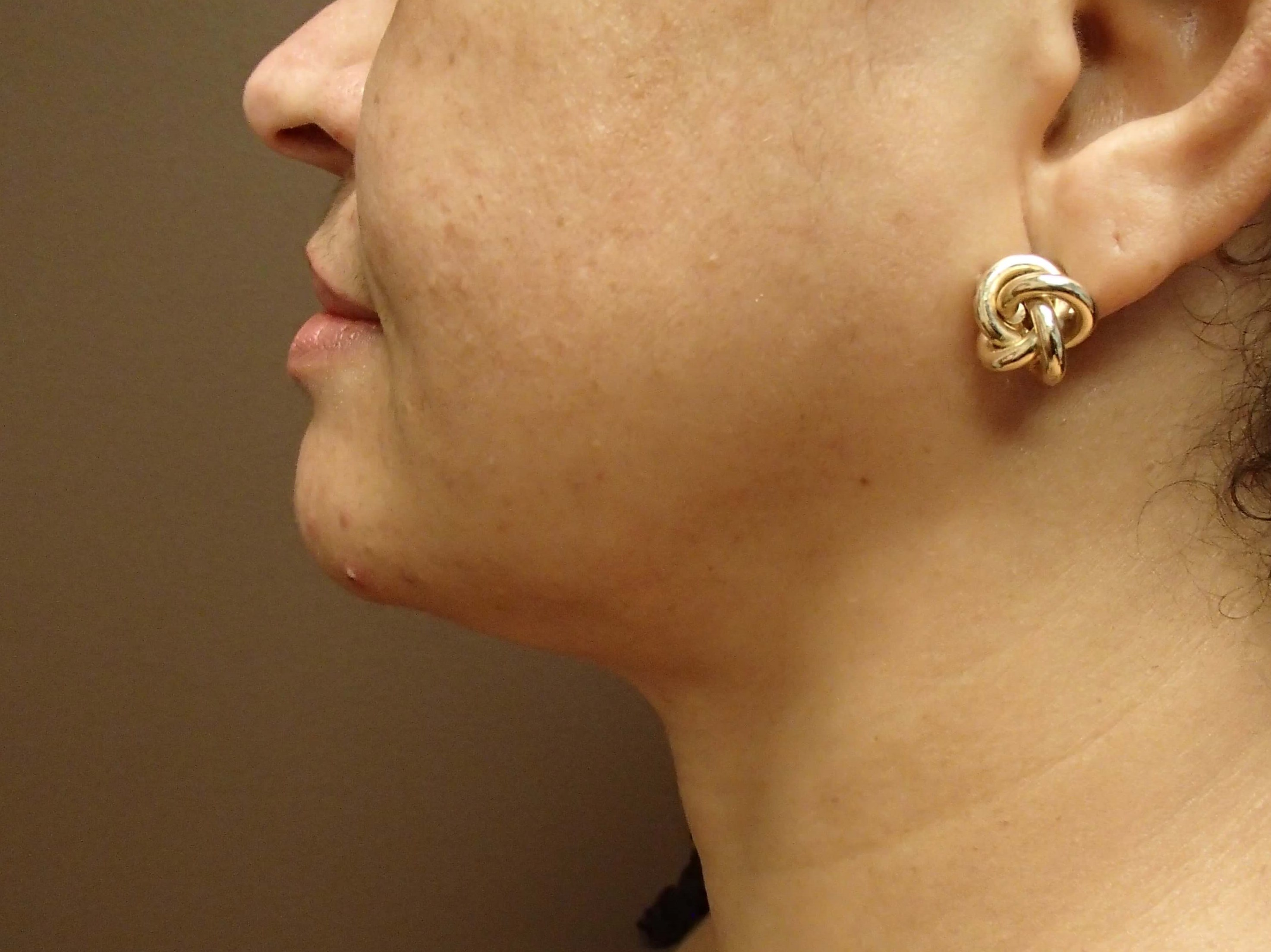 Neck Liposuction After