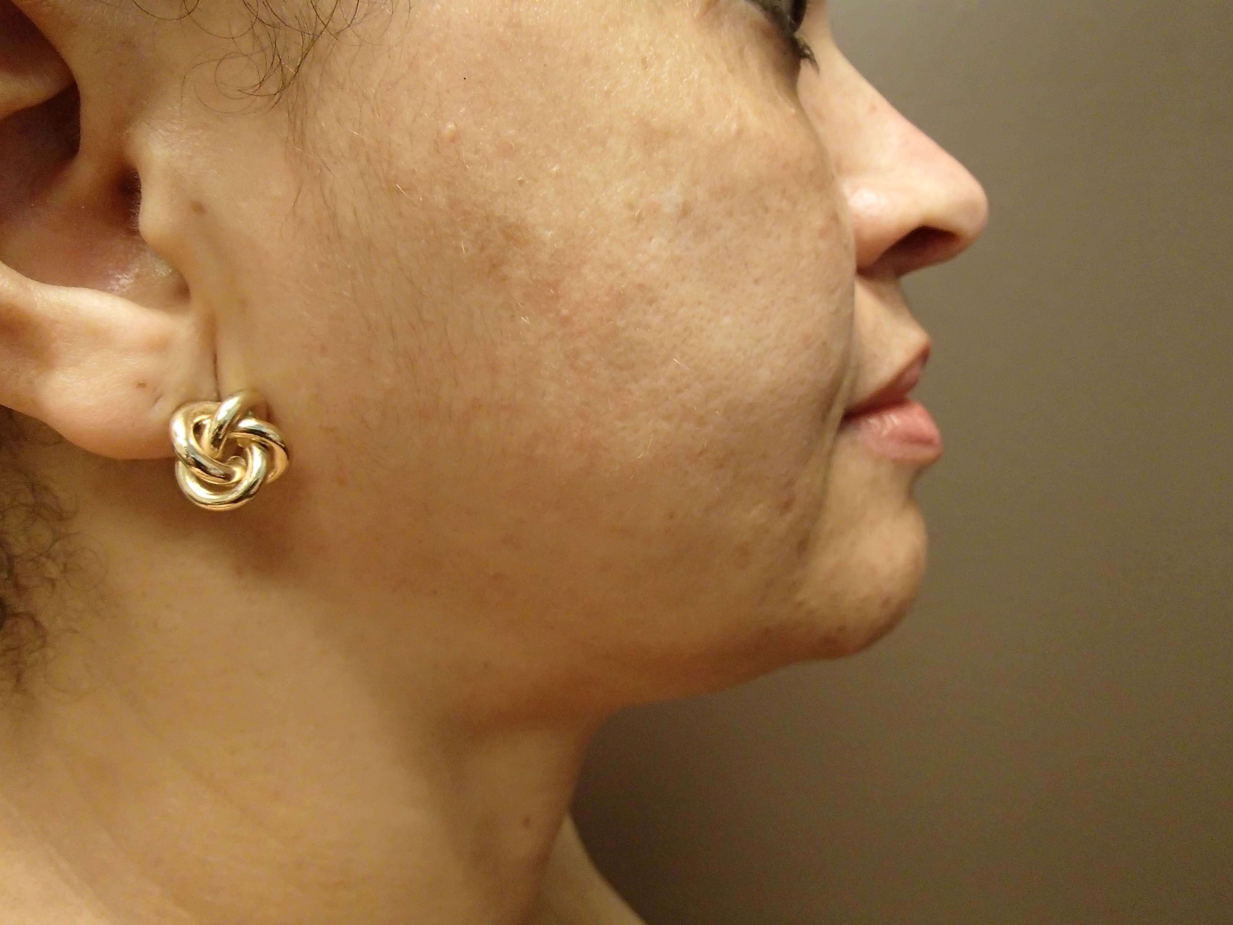 Neck Liposuction After