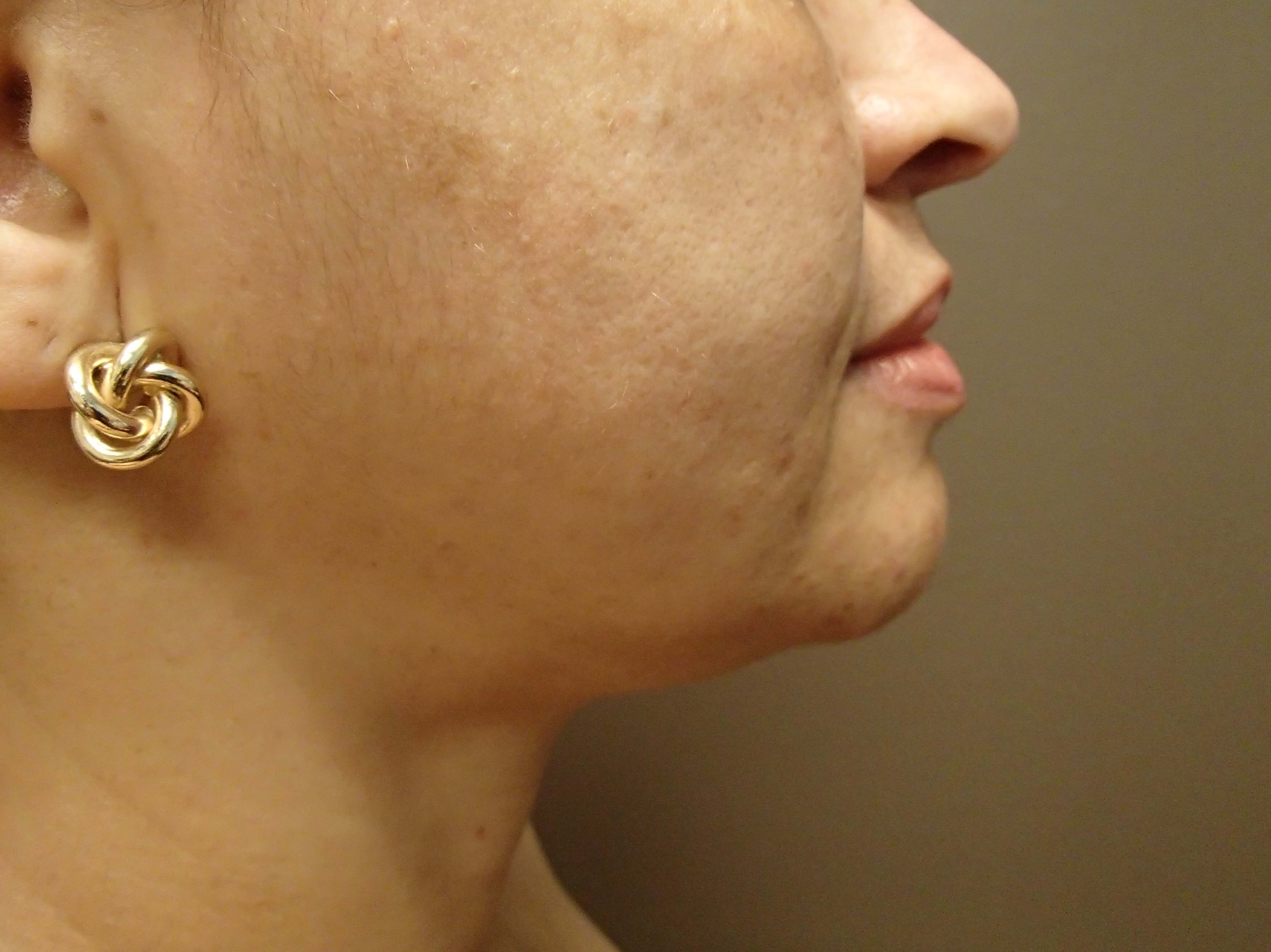 Neck Liposuction After