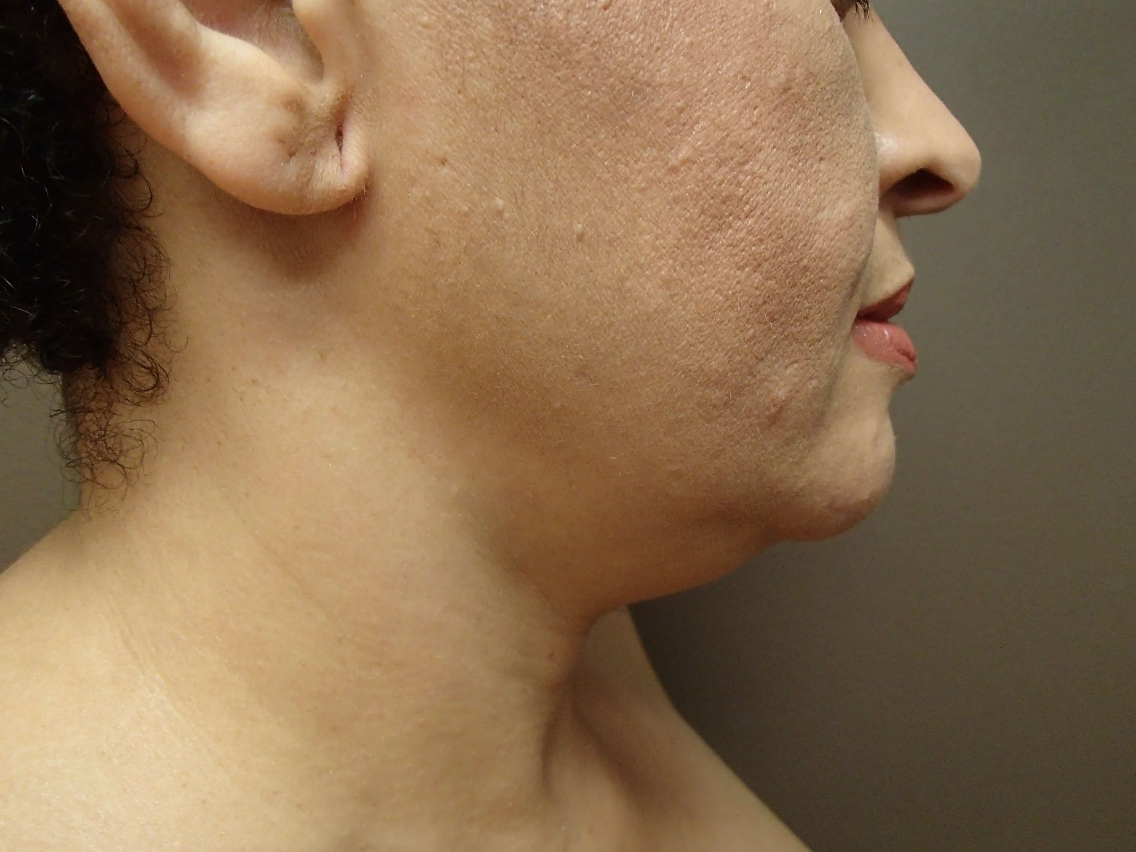 Neck Liposuction Before