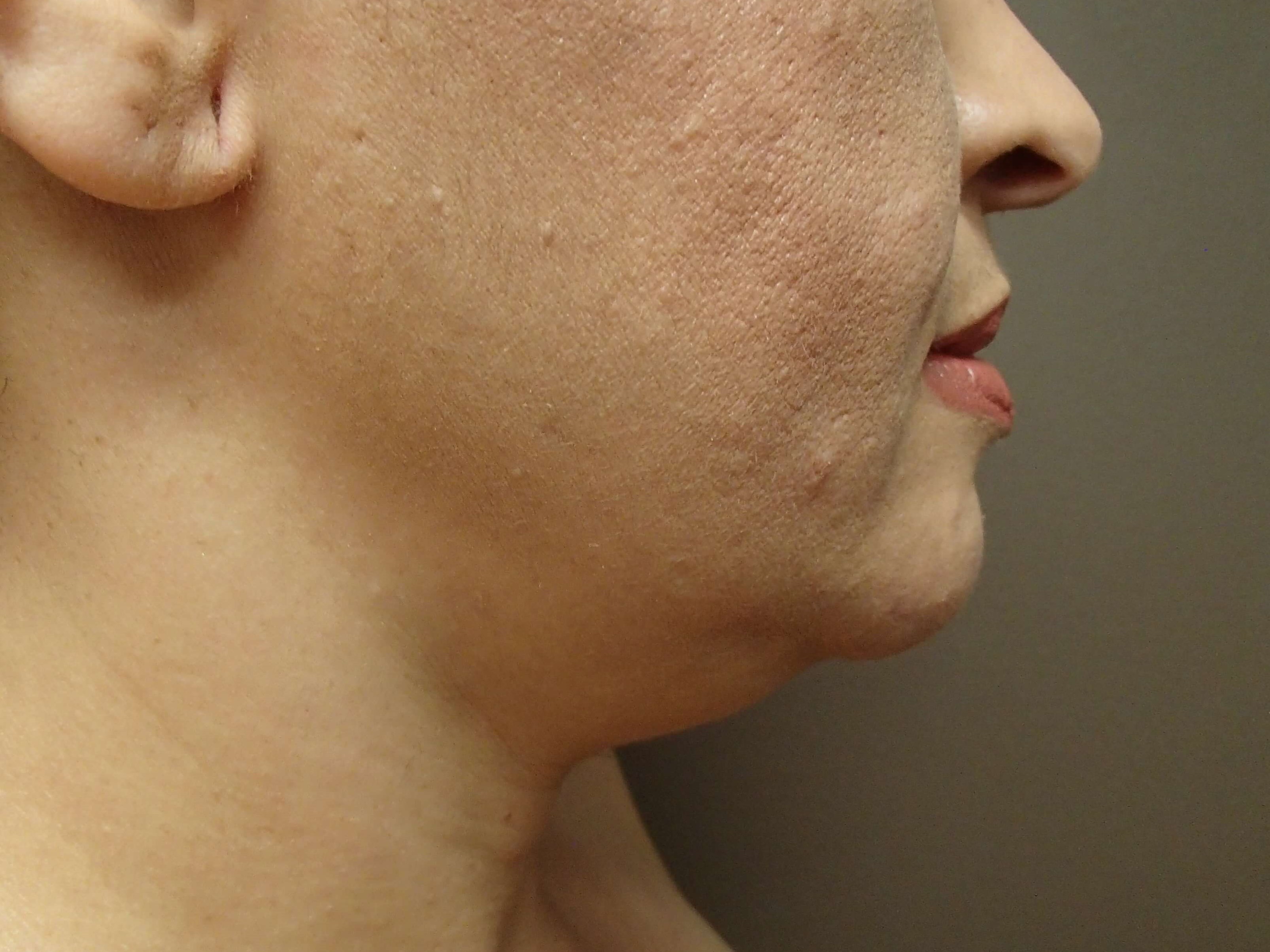 Neck Liposuction Before