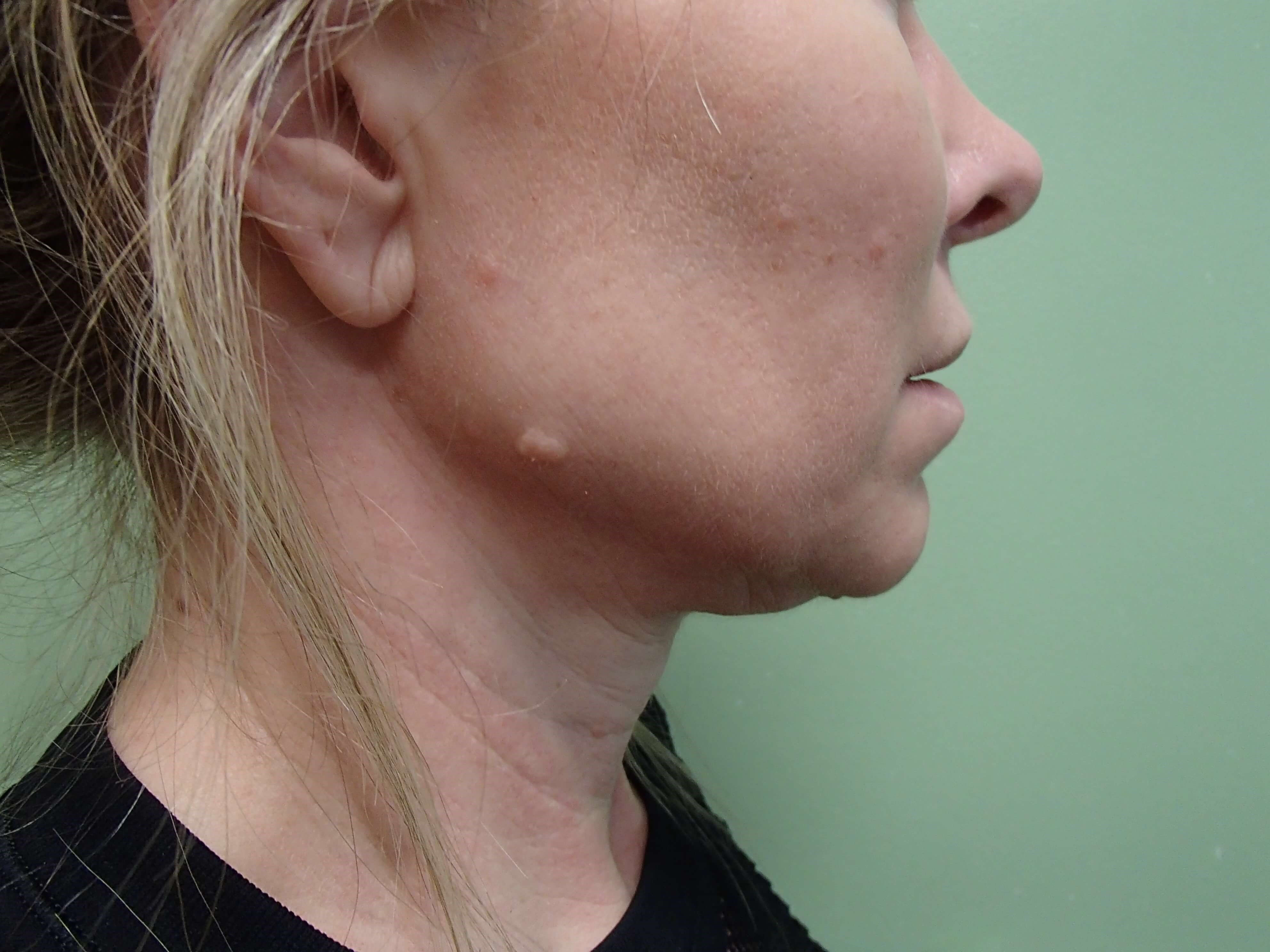 Neck Liposuction Before