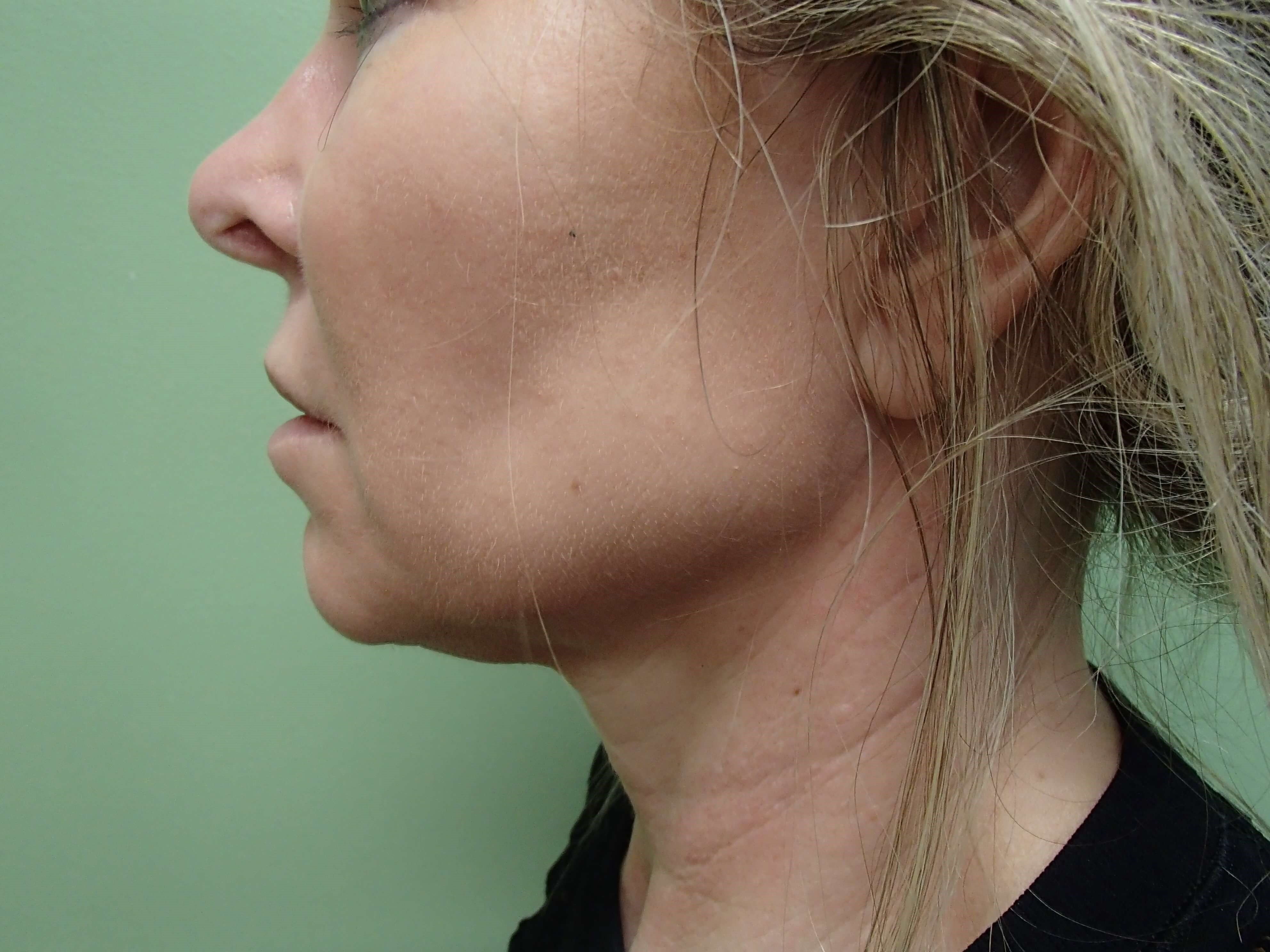 Neck Liposuction Before