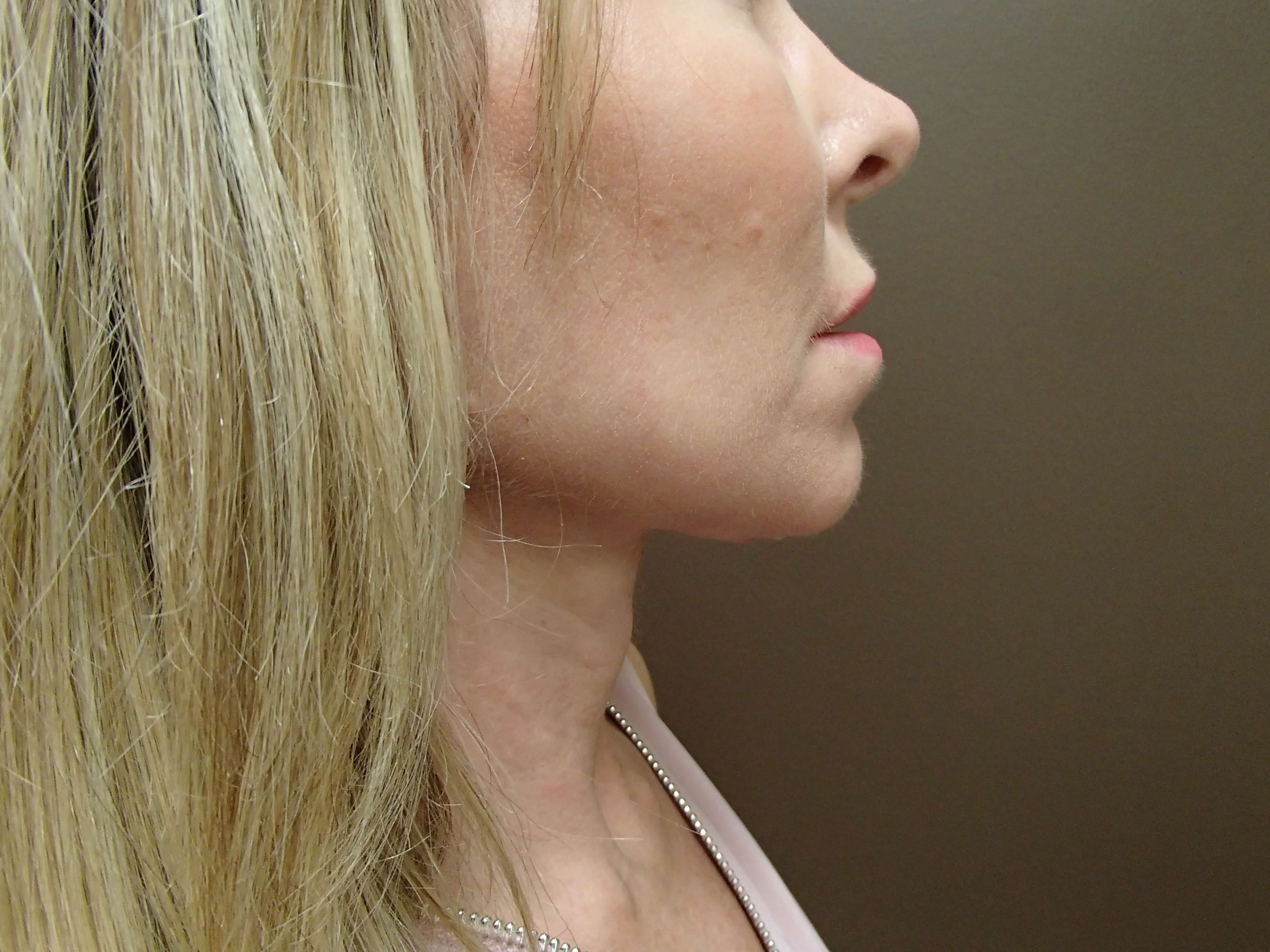 Neck Liposuction After