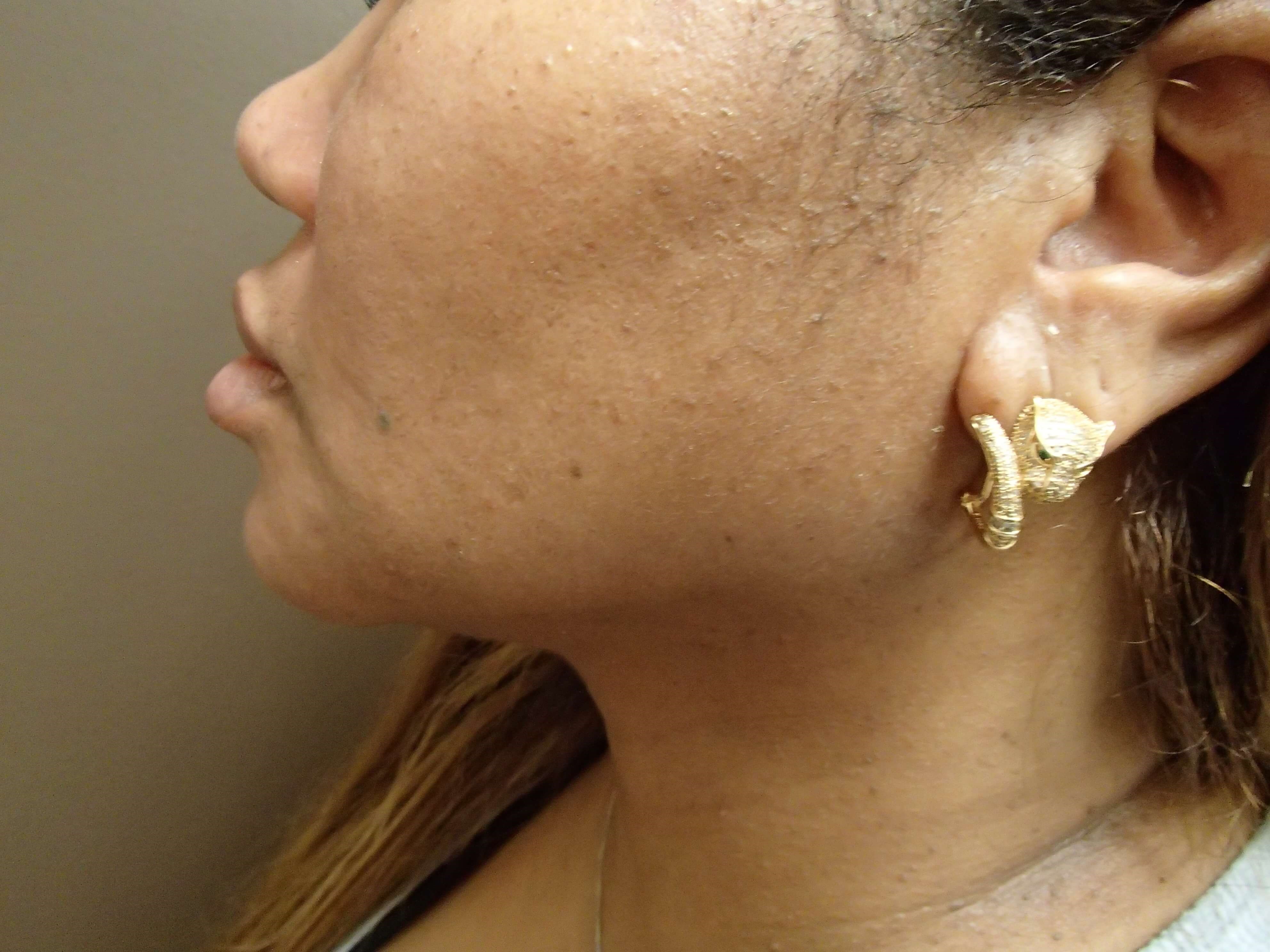 Neck Liposuction After