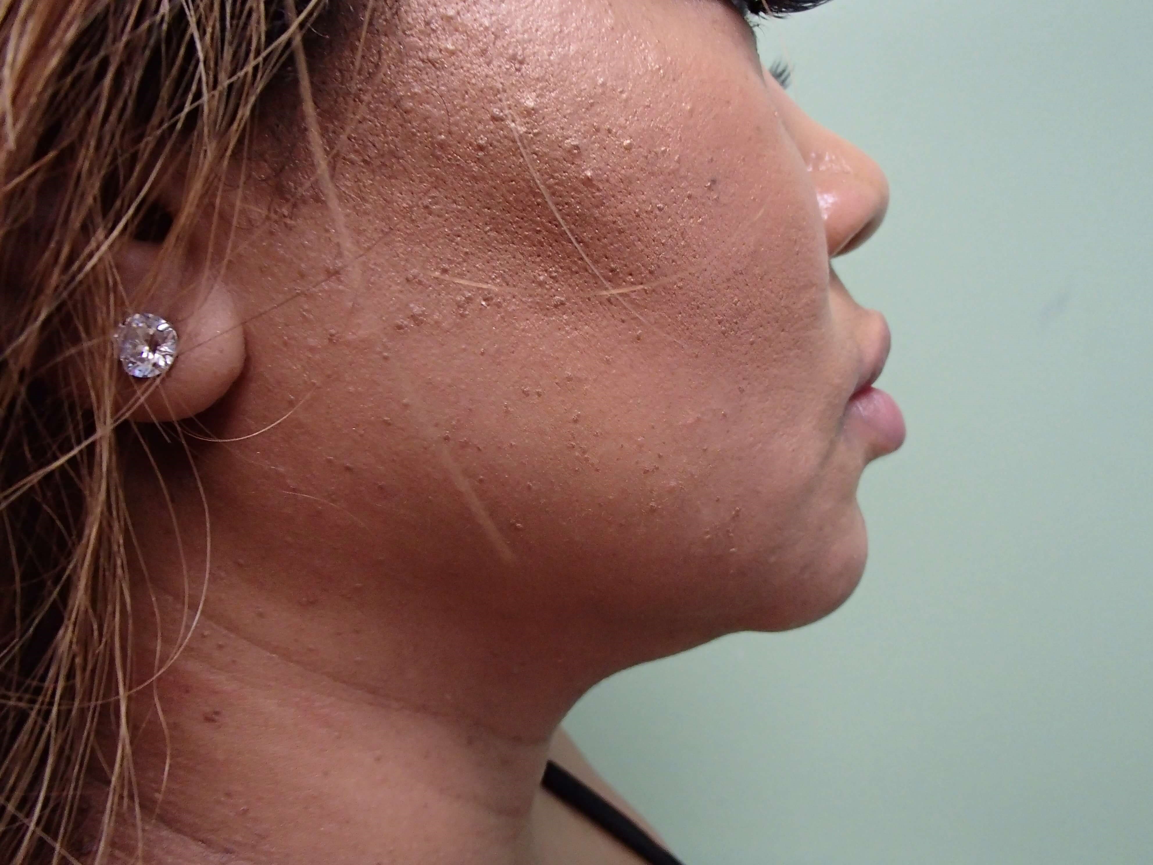 Neck Liposuction Before