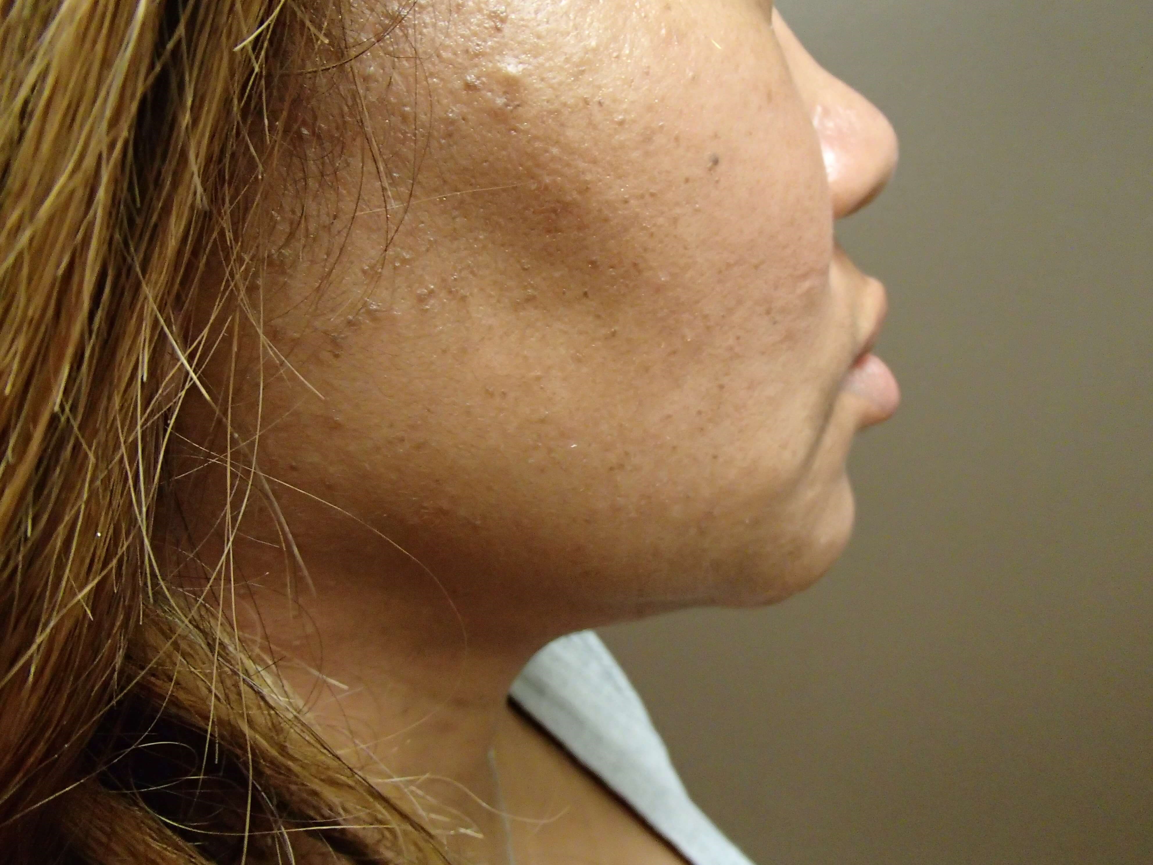 Neck Liposuction After