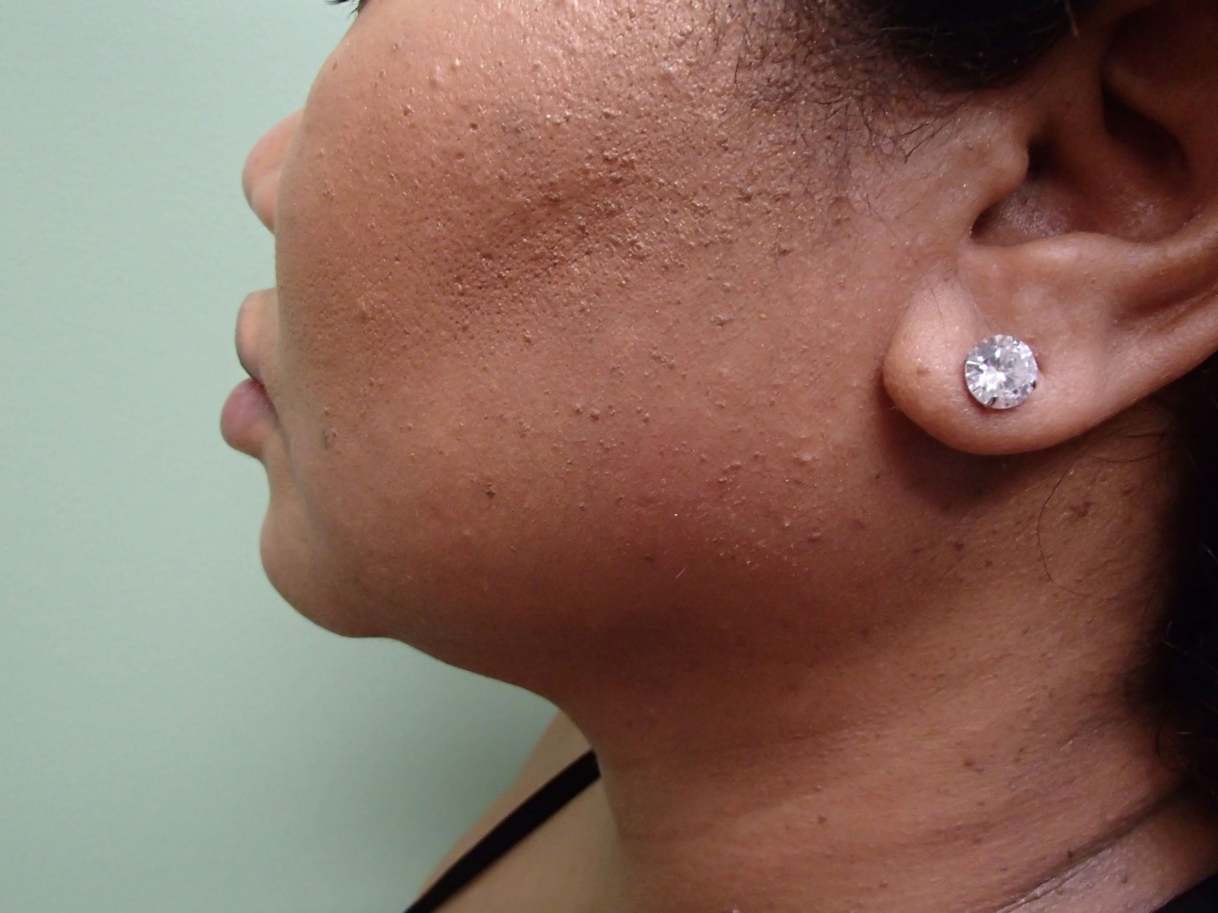 Neck Liposuction Before