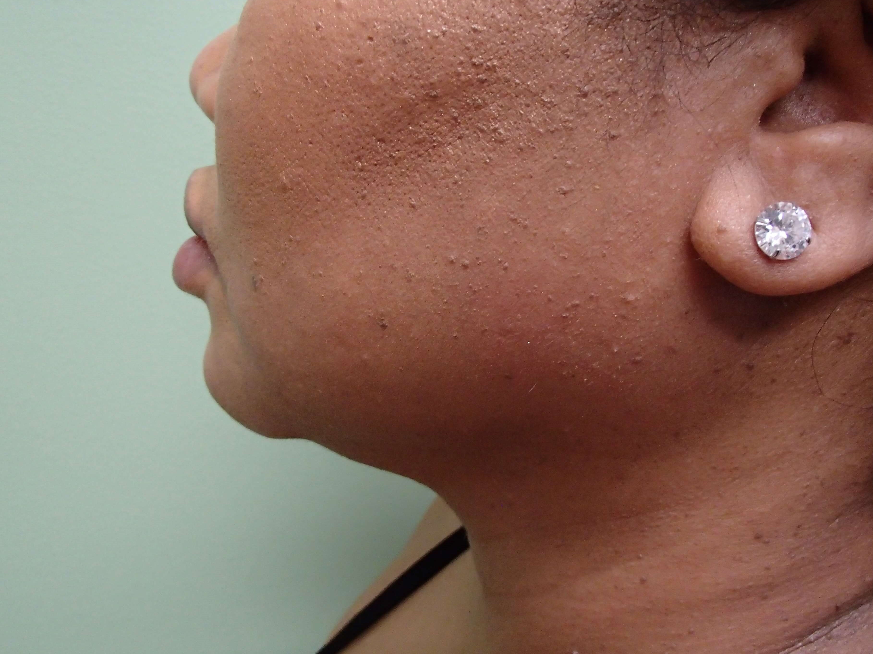 Neck Liposuction Before