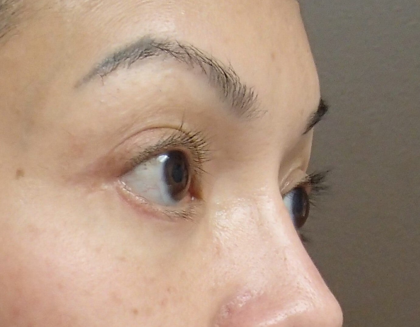 Blepharoplasty After