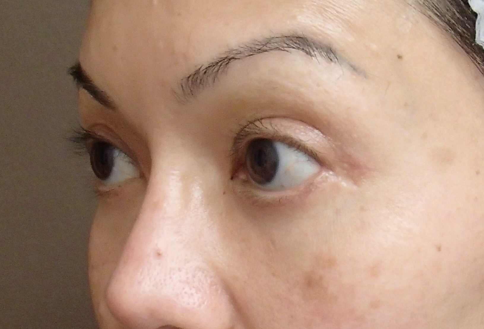 Blepharoplasty After