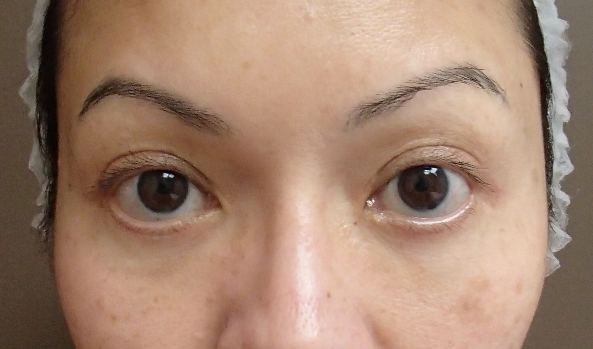 Blepharoplasty After