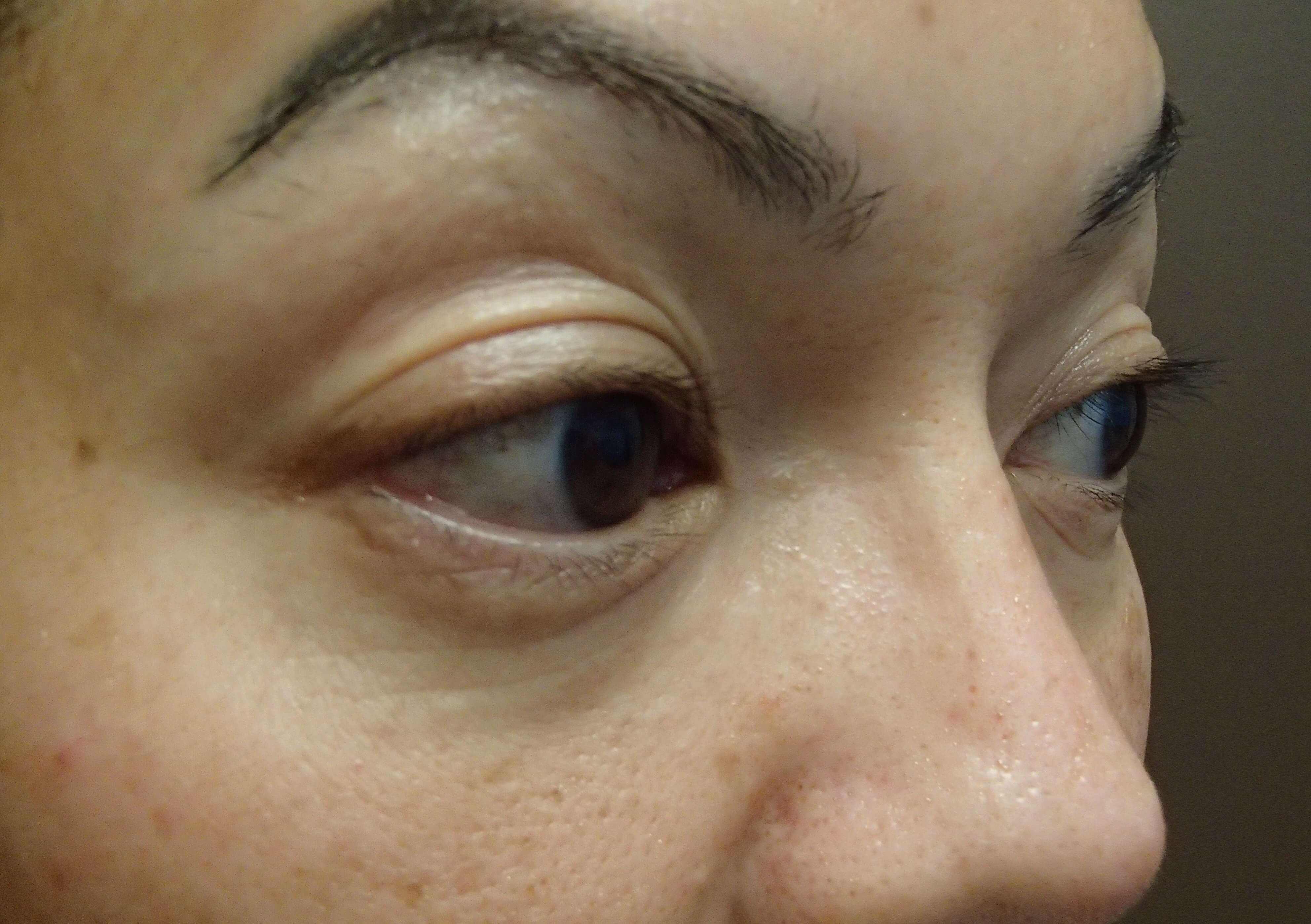 Blepharoplasty Before
