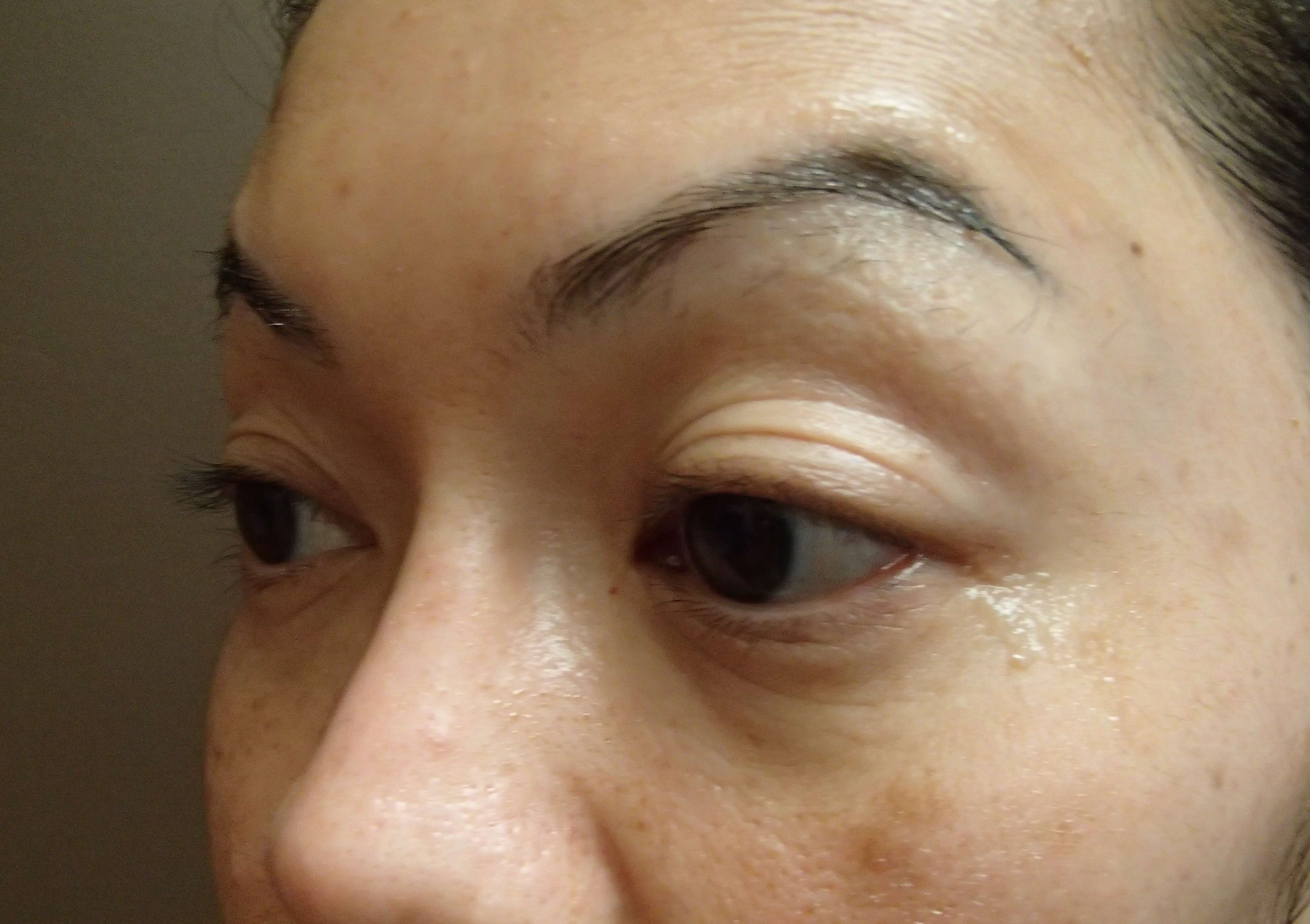 Blepharoplasty Before
