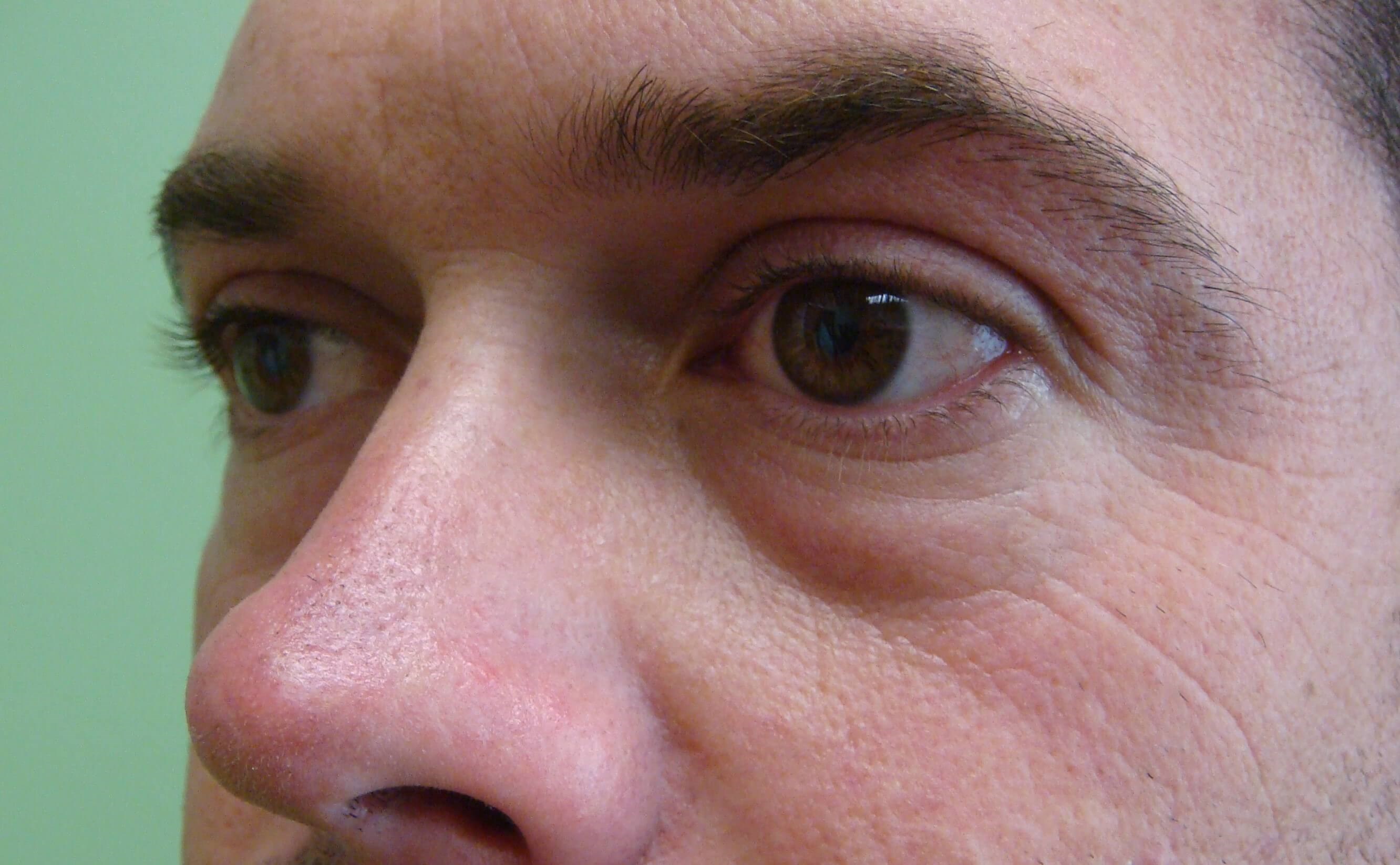 Blepharoplasty Before