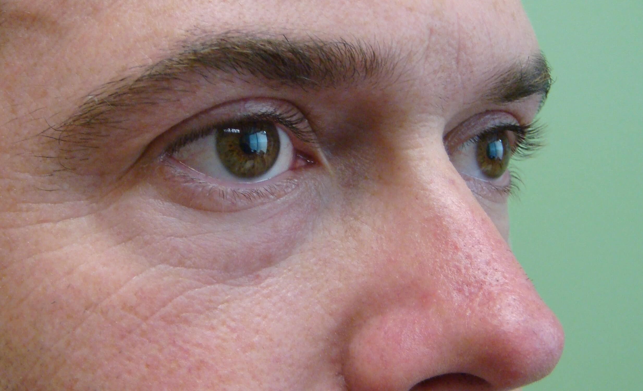 Blepharoplasty Before