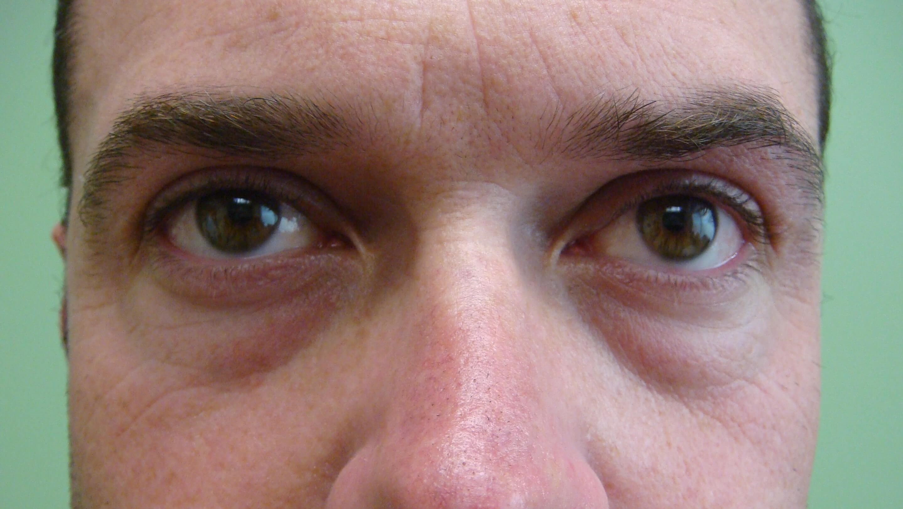 Blepharoplasty Before