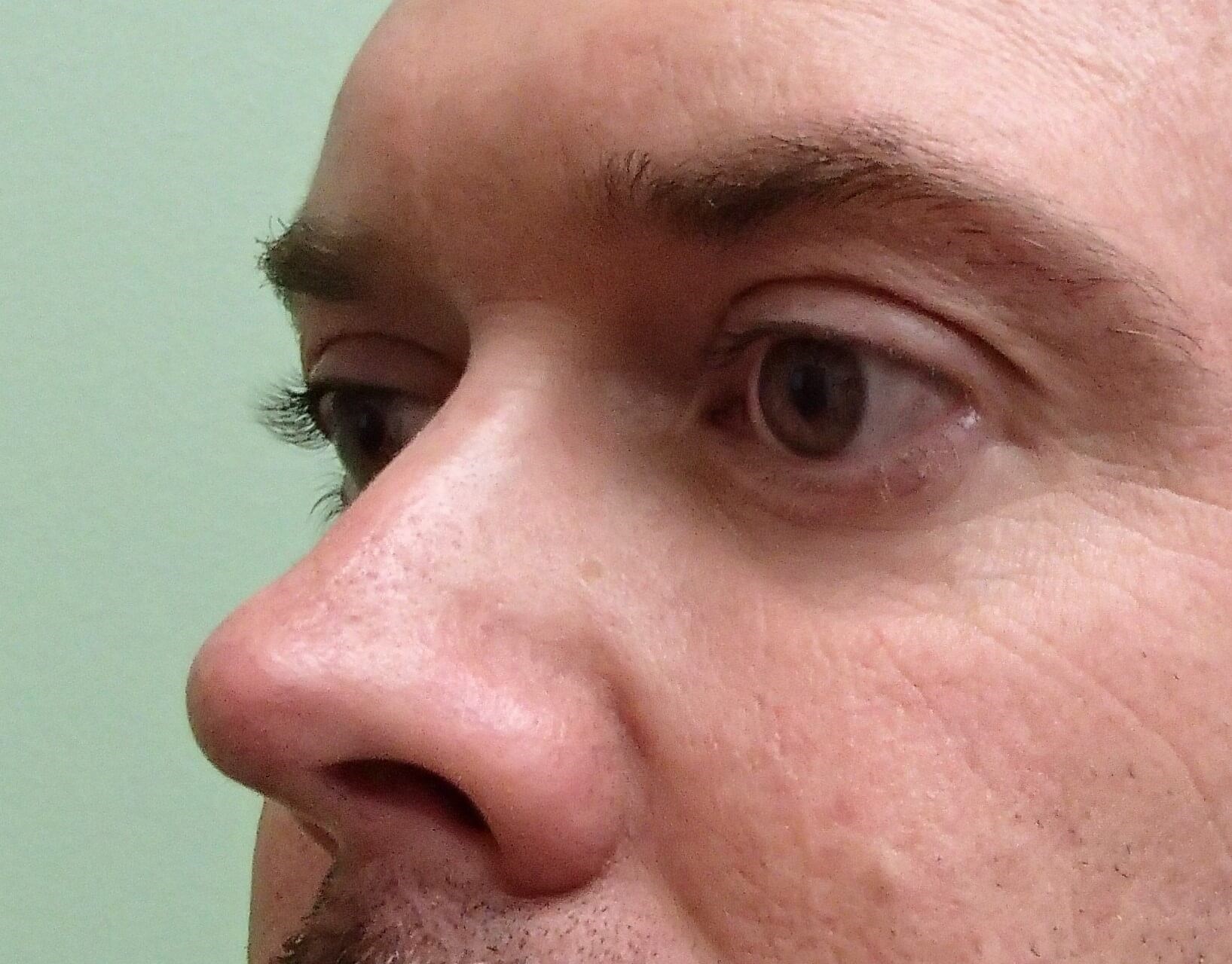 Blepharoplasty After
