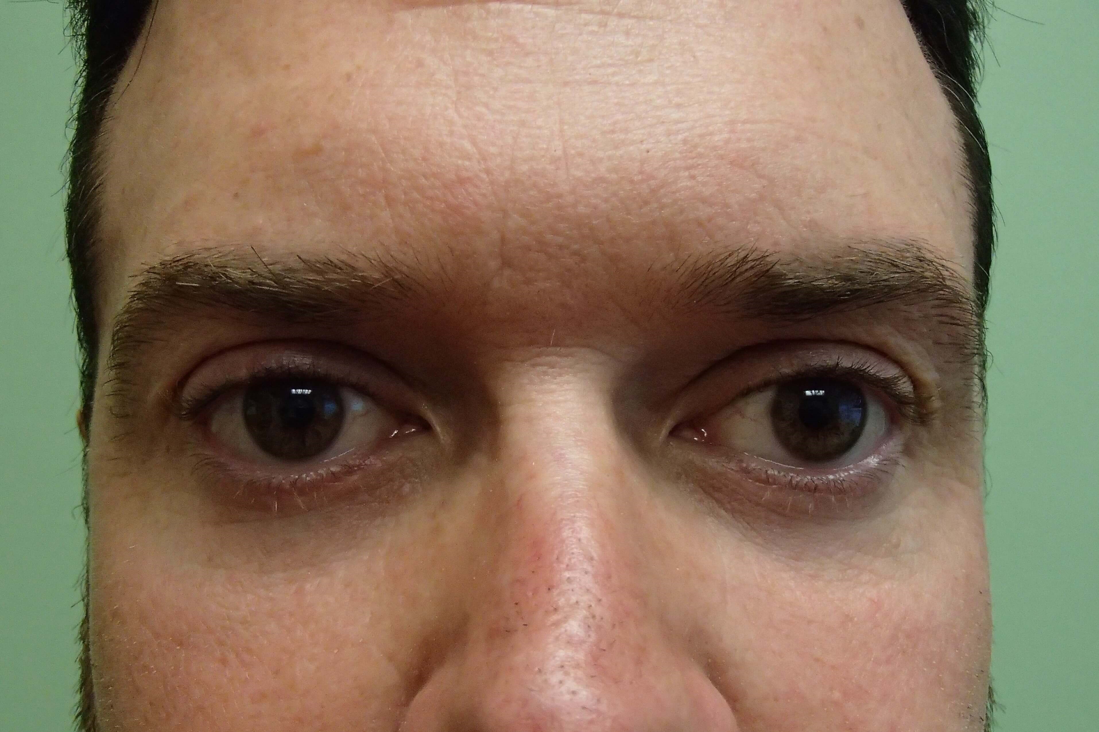 Blepharoplasty After