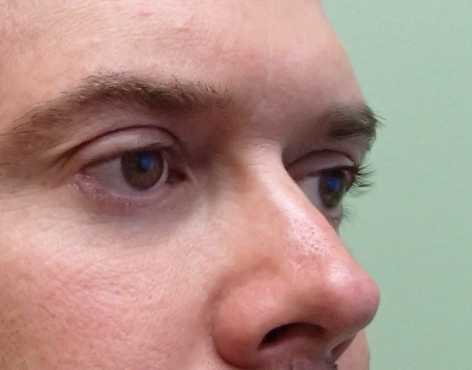 Blepharoplasty After
