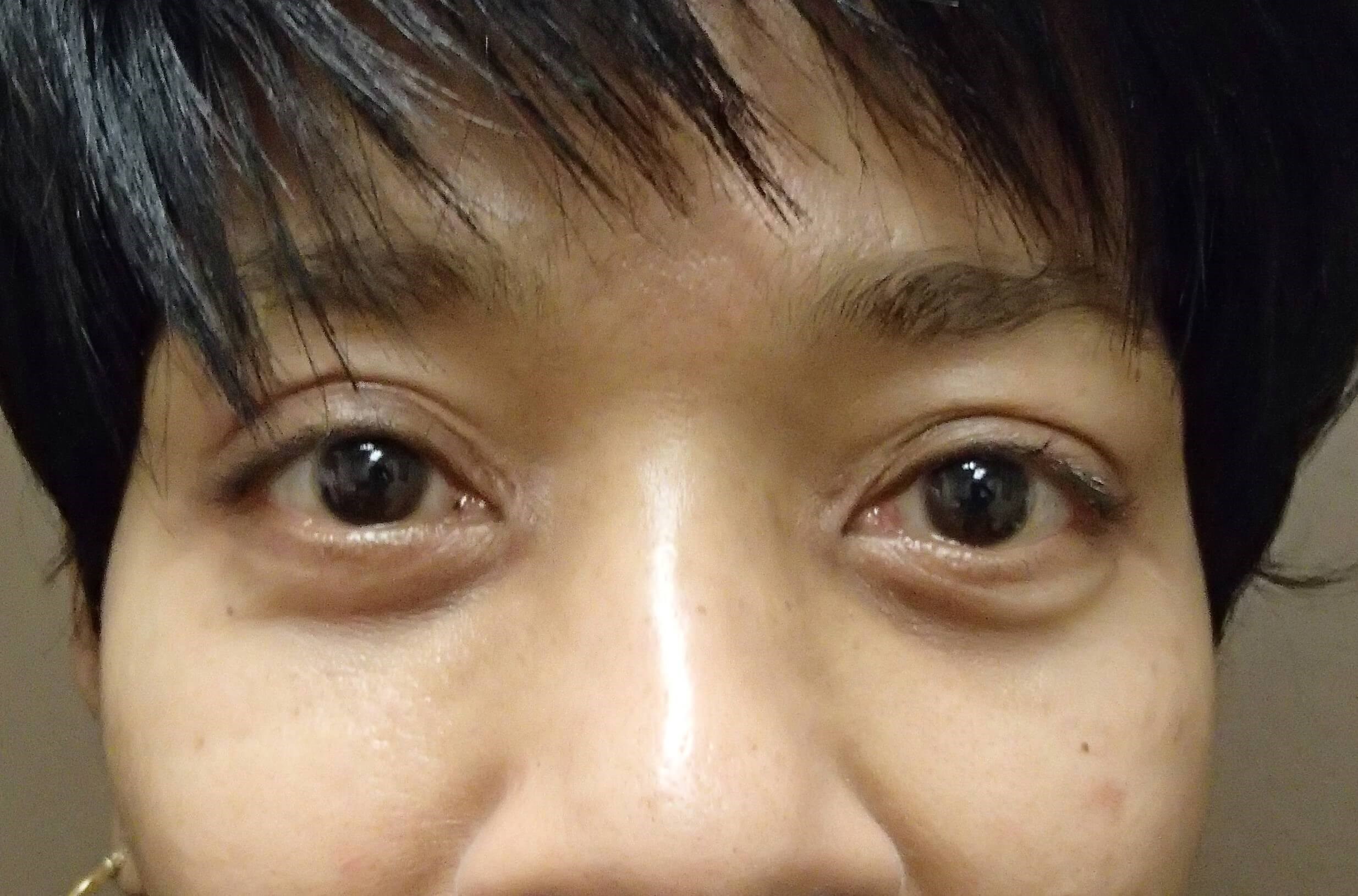 Blepharoplasty After