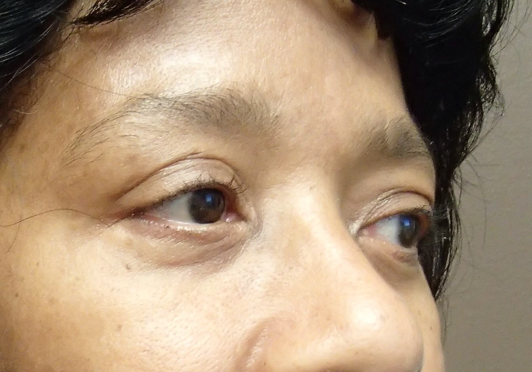 Blepharoplasty After