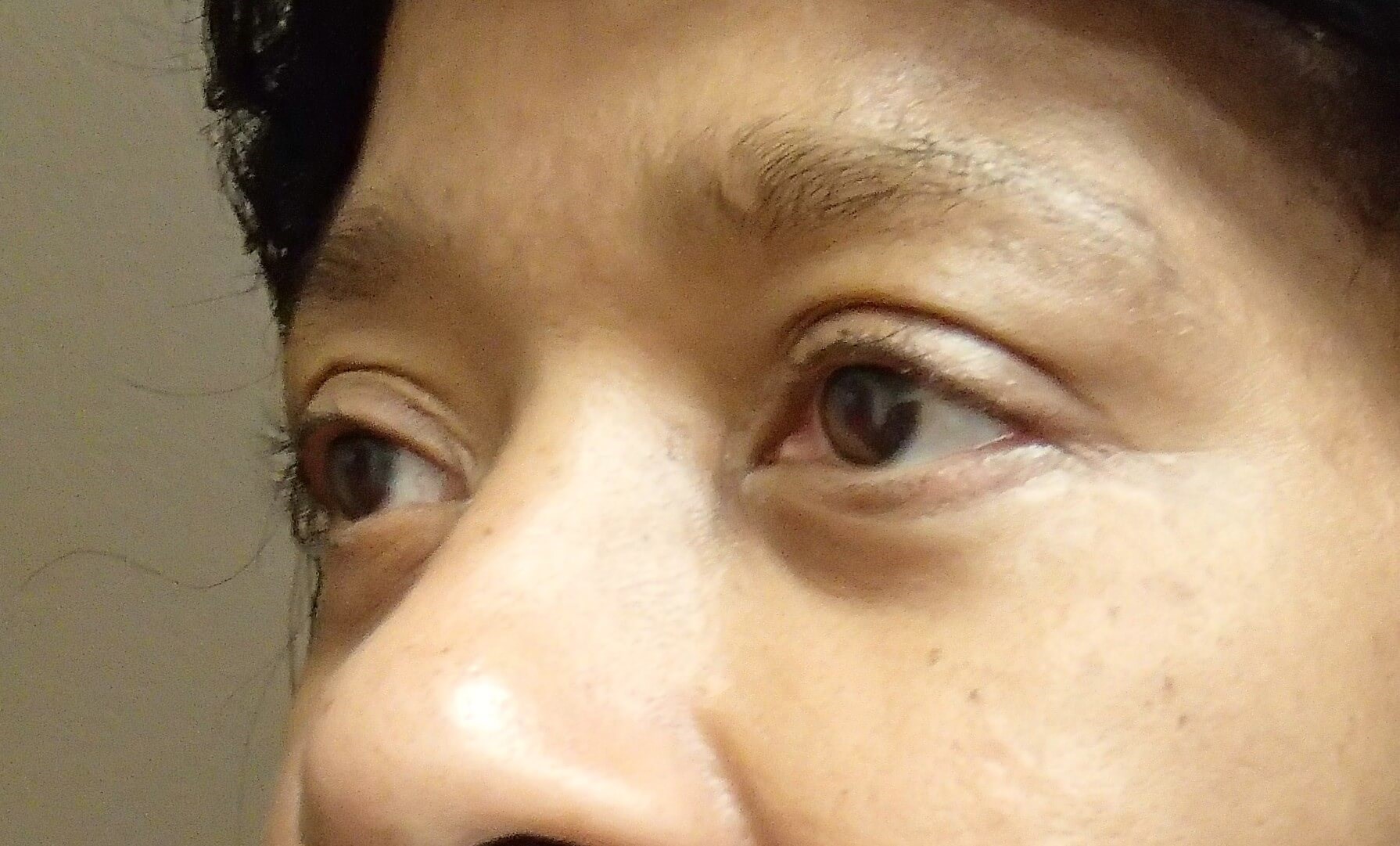 Blepharoplasty After