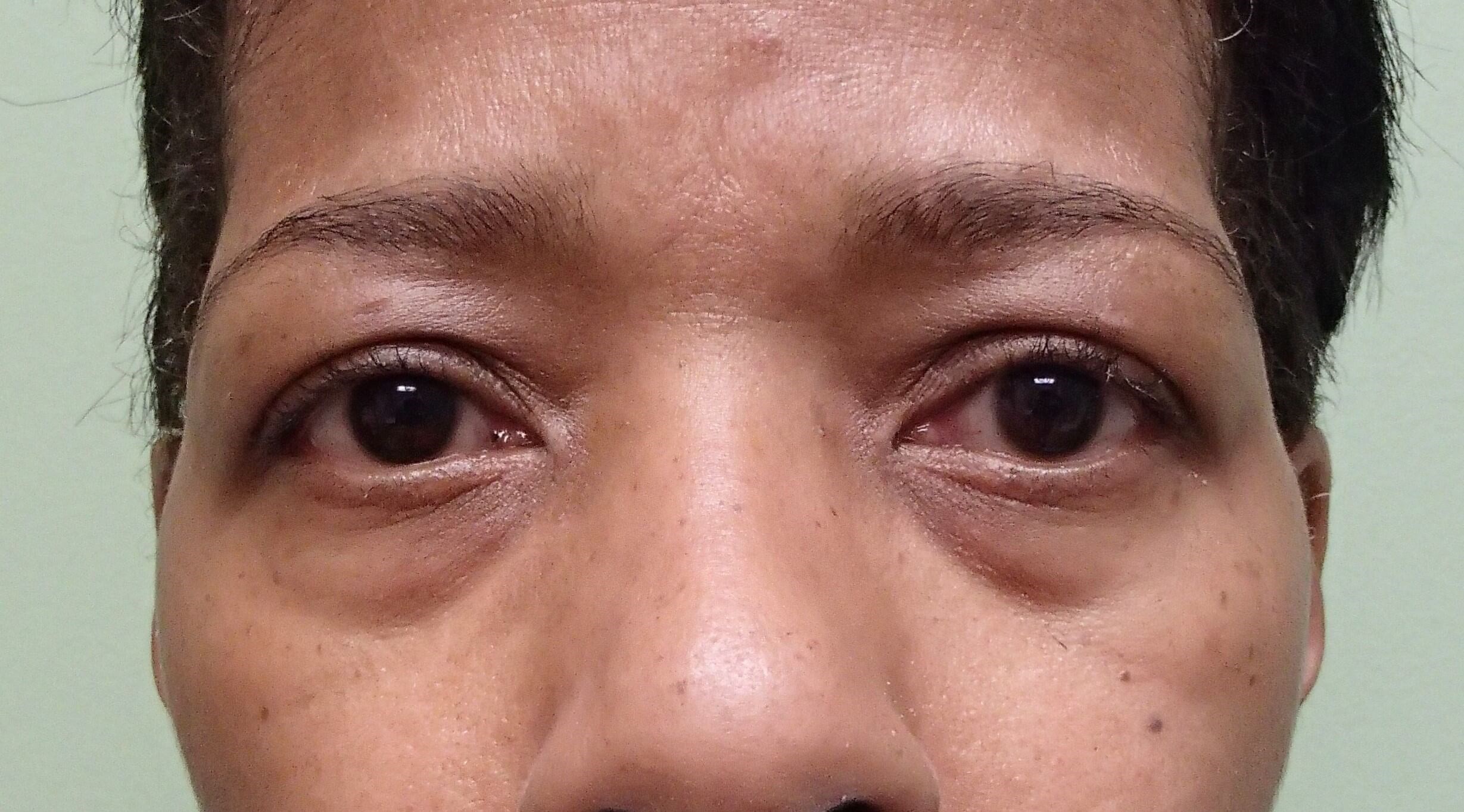 Blepharoplasty Before