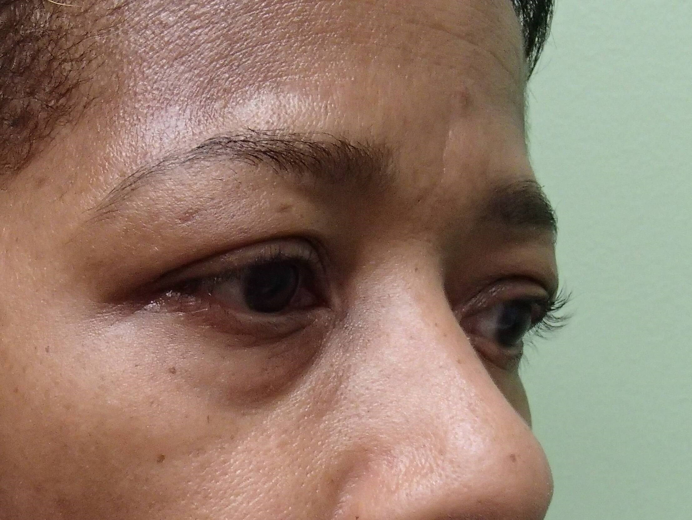 Blepharoplasty Before