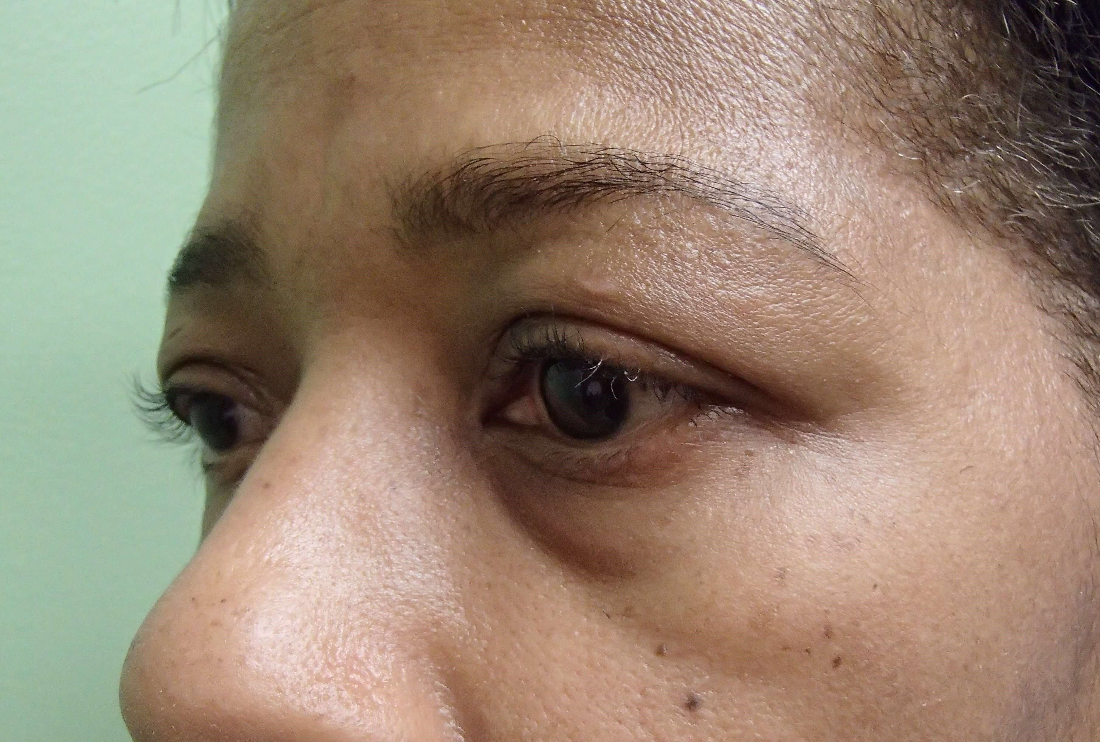 Blepharoplasty Before