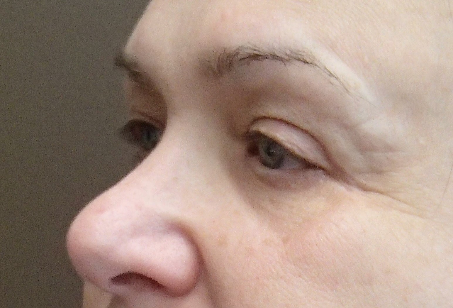 Blepharoplasty After