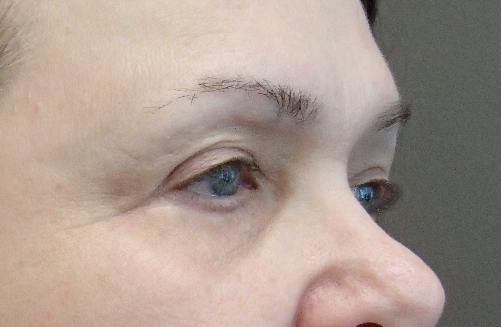 Blepharoplasty After