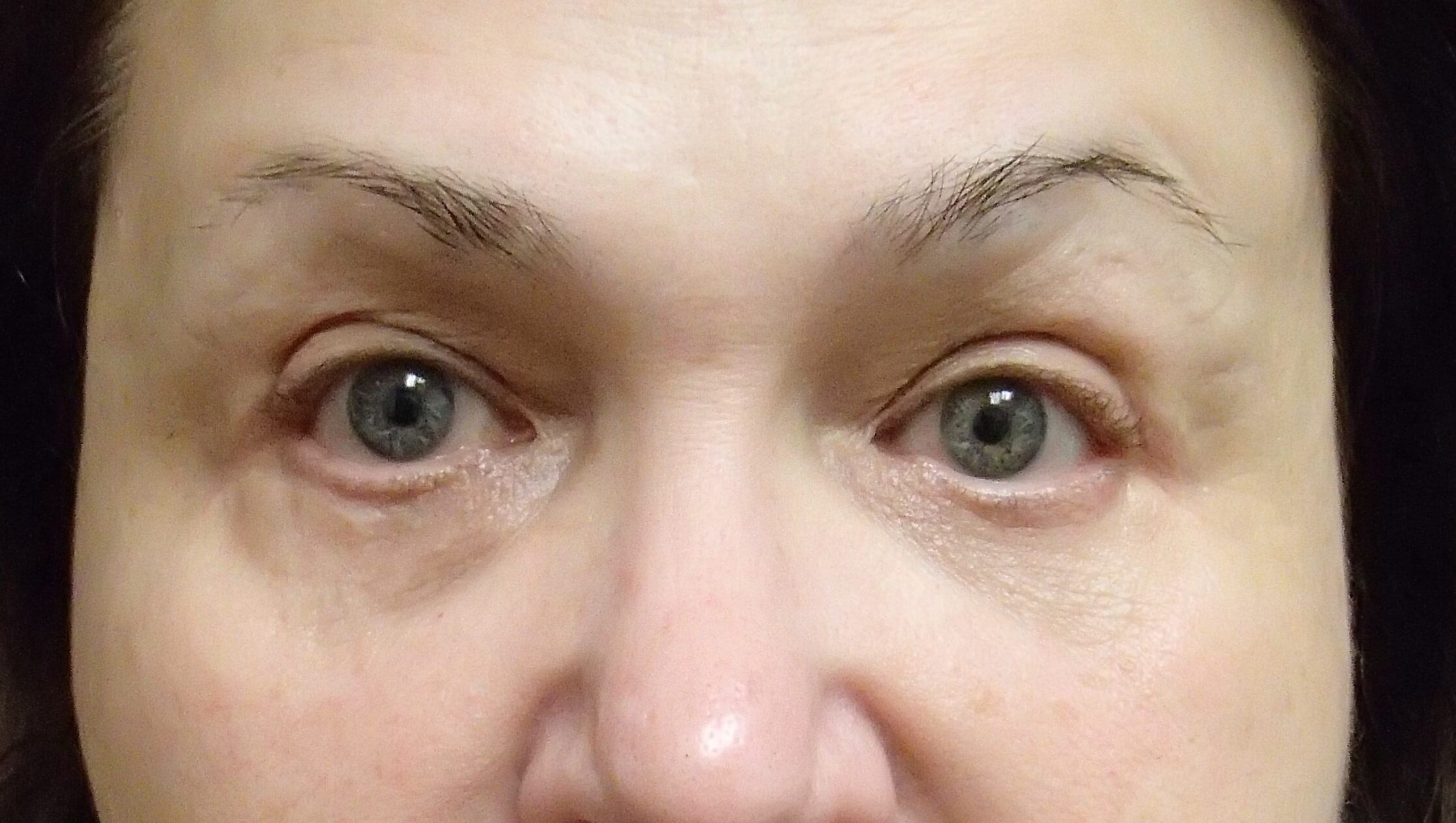 Blepharoplasty After