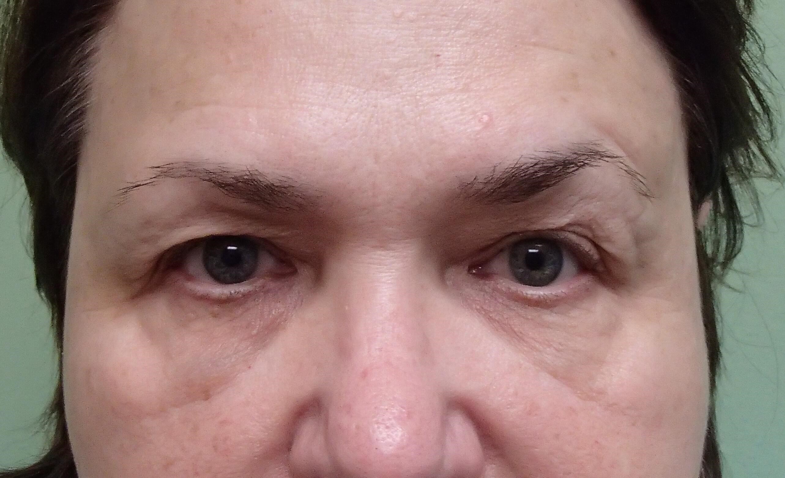 Blepharoplasty Before