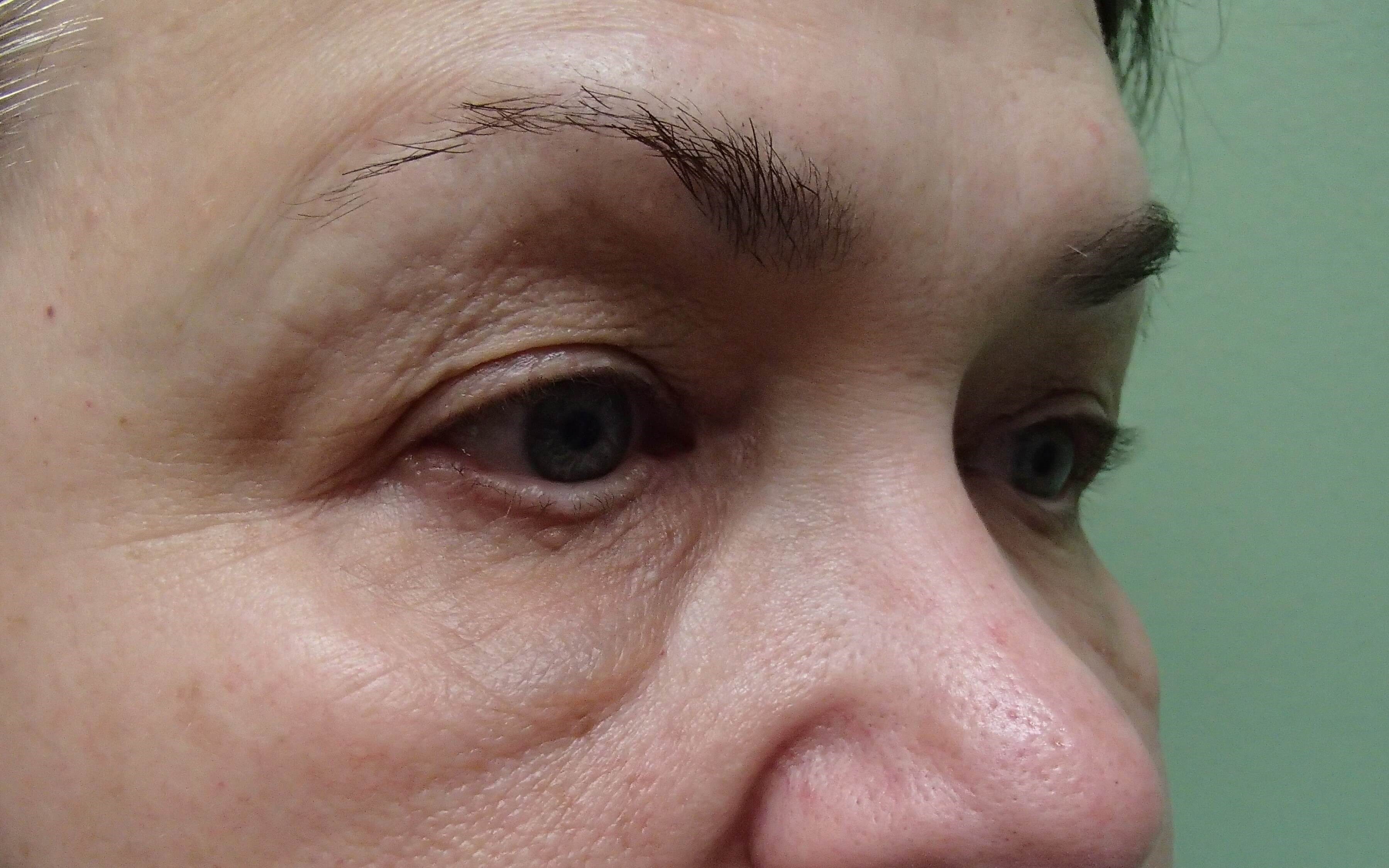 Blepharoplasty Before